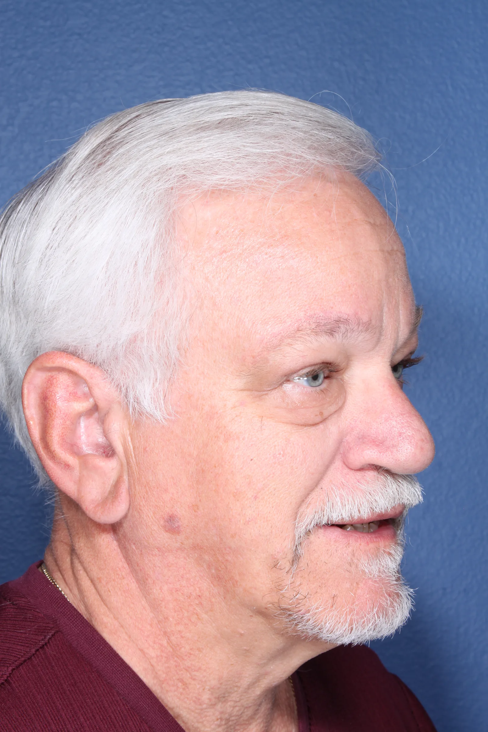 Detail brow and forehead lifts case 1 at Skin Secrets