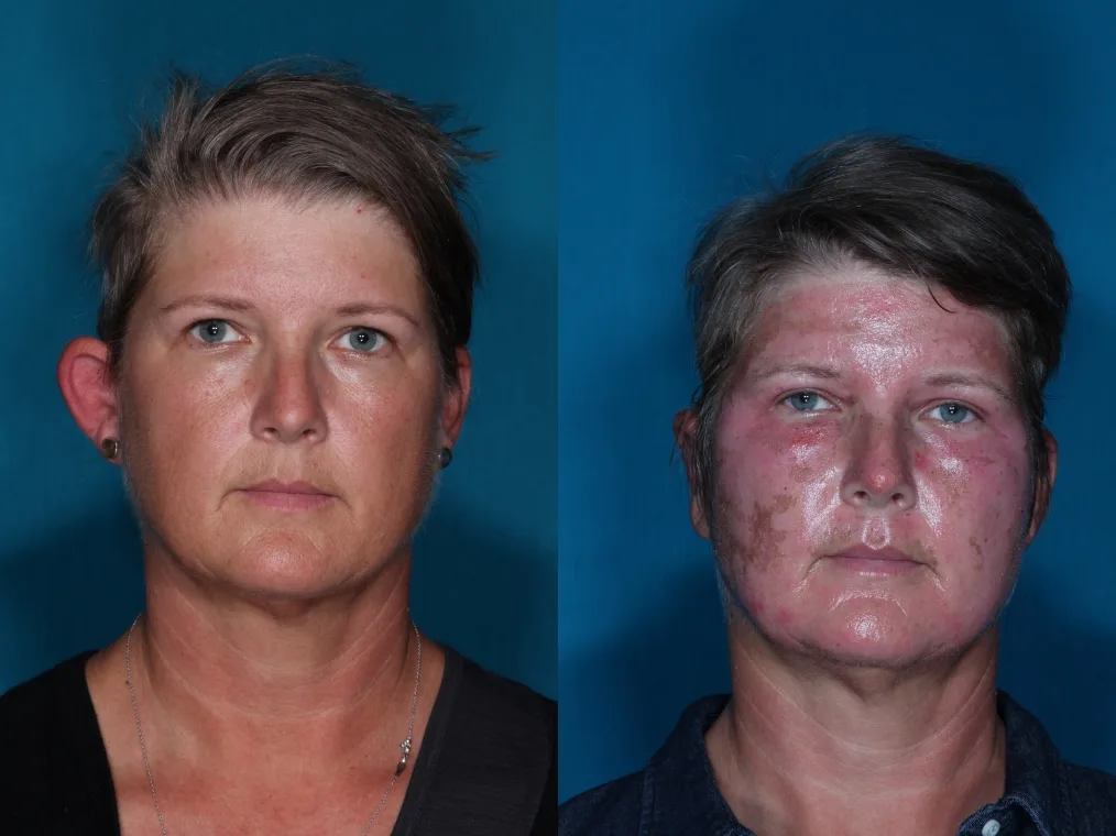 Detail otoplasty case 1 at Skin Secrets