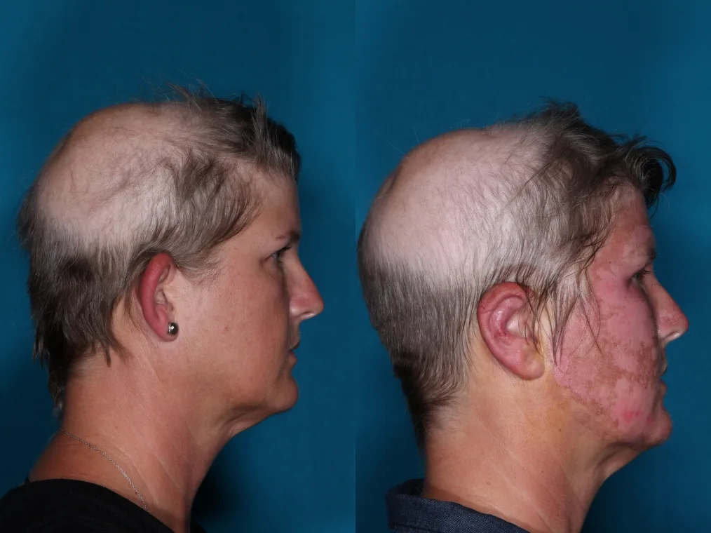 Detail otoplasty case 1 at Skin Secrets