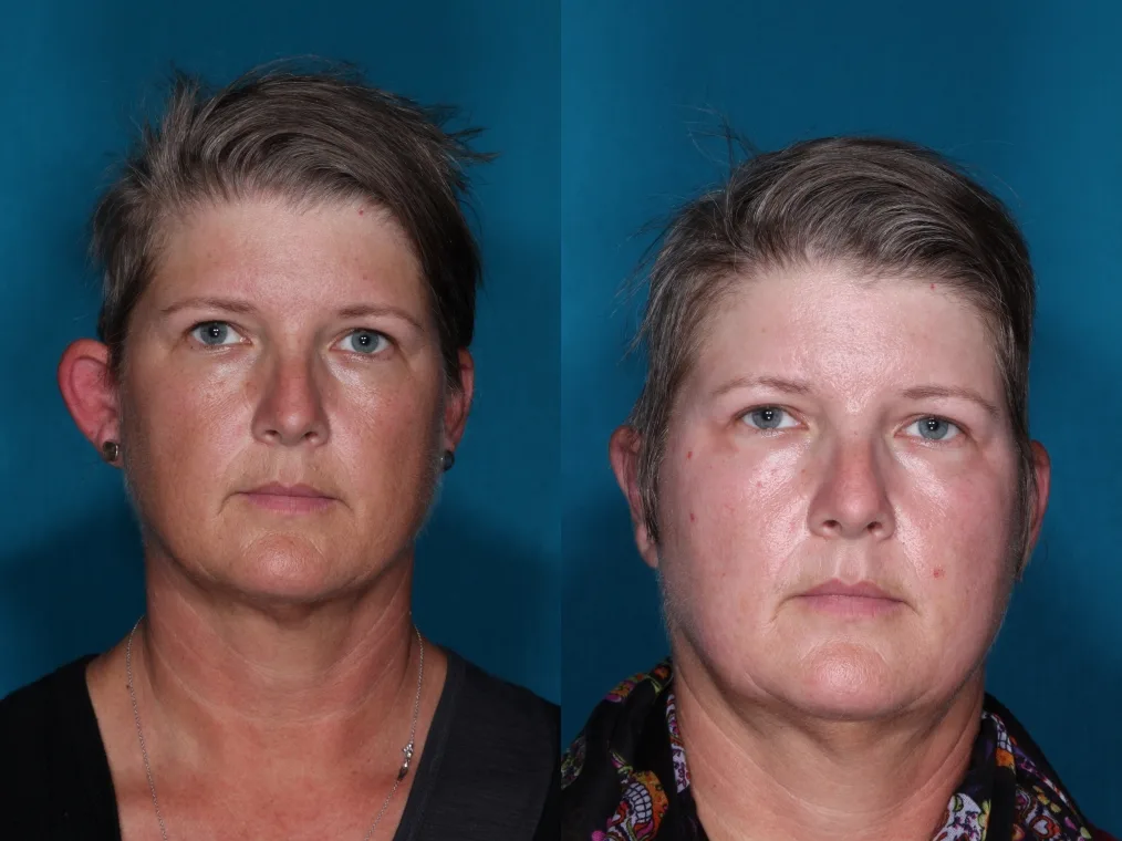 Detail otoplasty case 1 at Skin Secrets