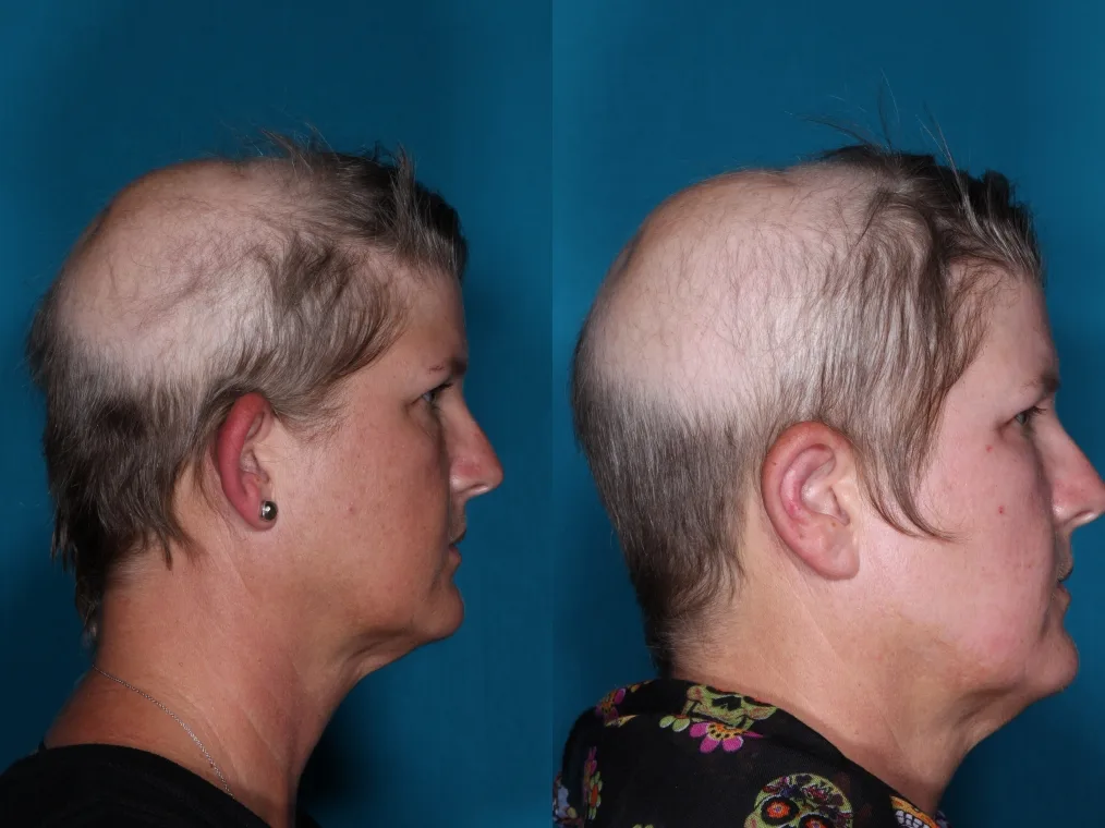 Detail otoplasty case 1 at Skin Secrets