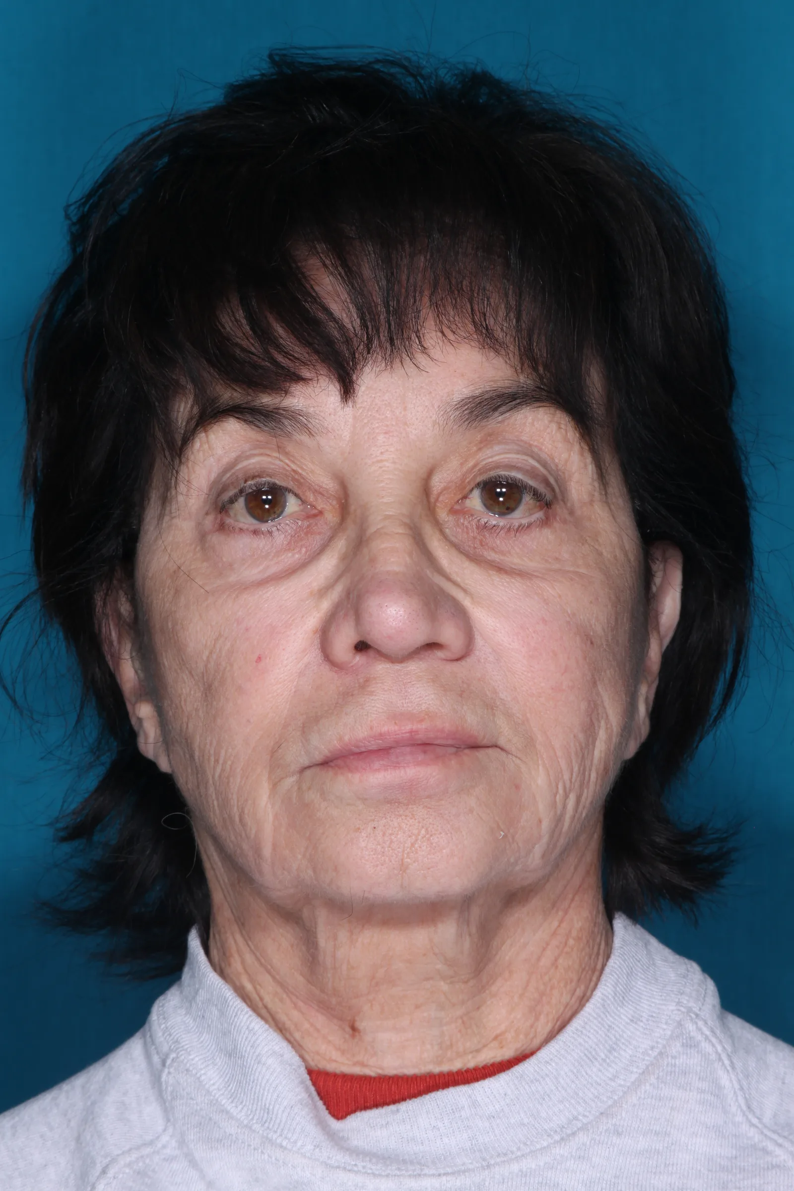 Detail face and neck lift case 1 at Skin Secrets