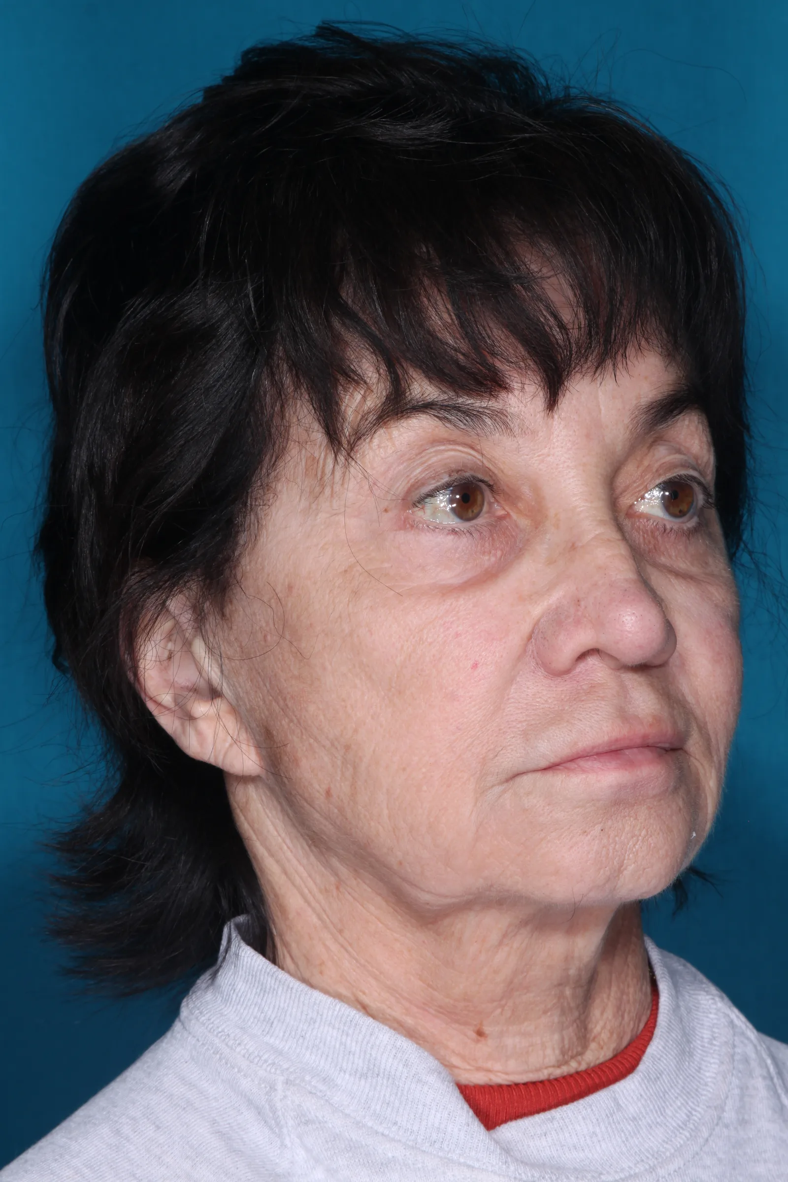 Detail face and neck lift case 1 at Skin Secrets