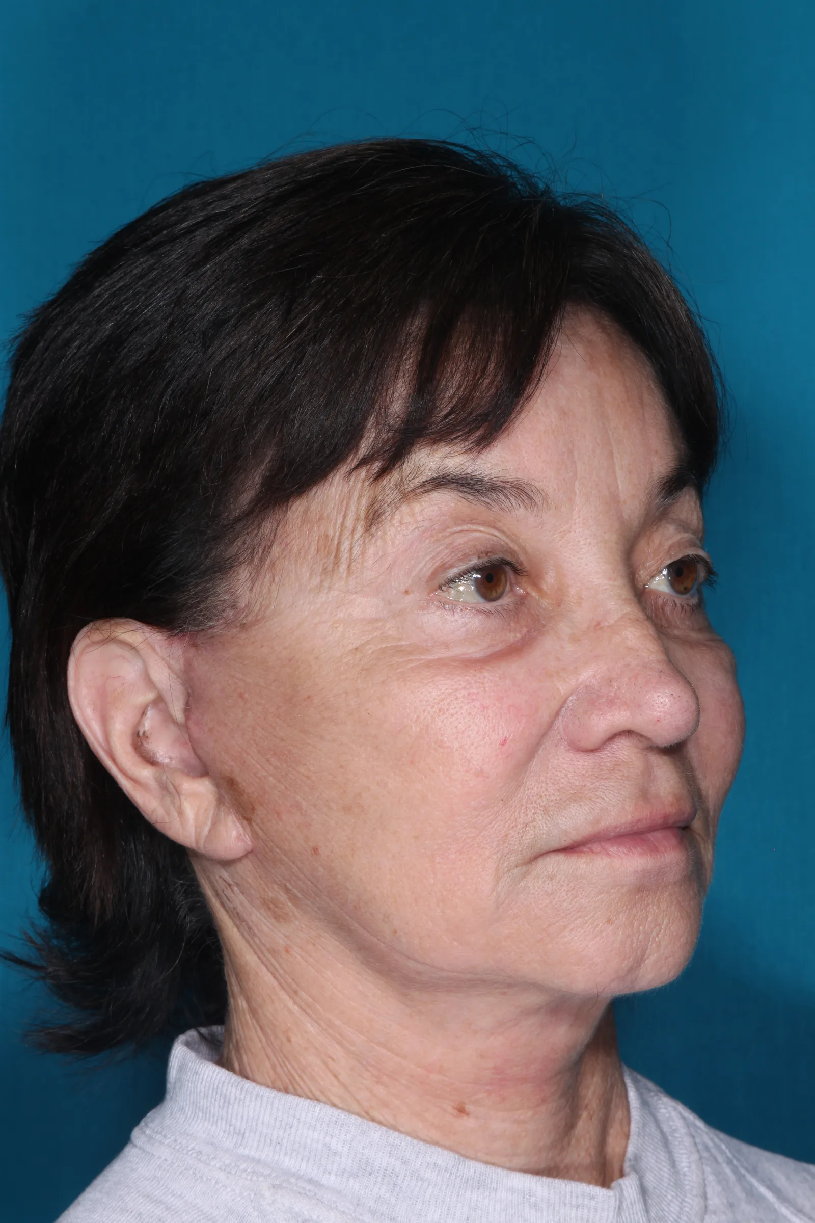 Detail face and neck lift case 1 at Skin Secrets