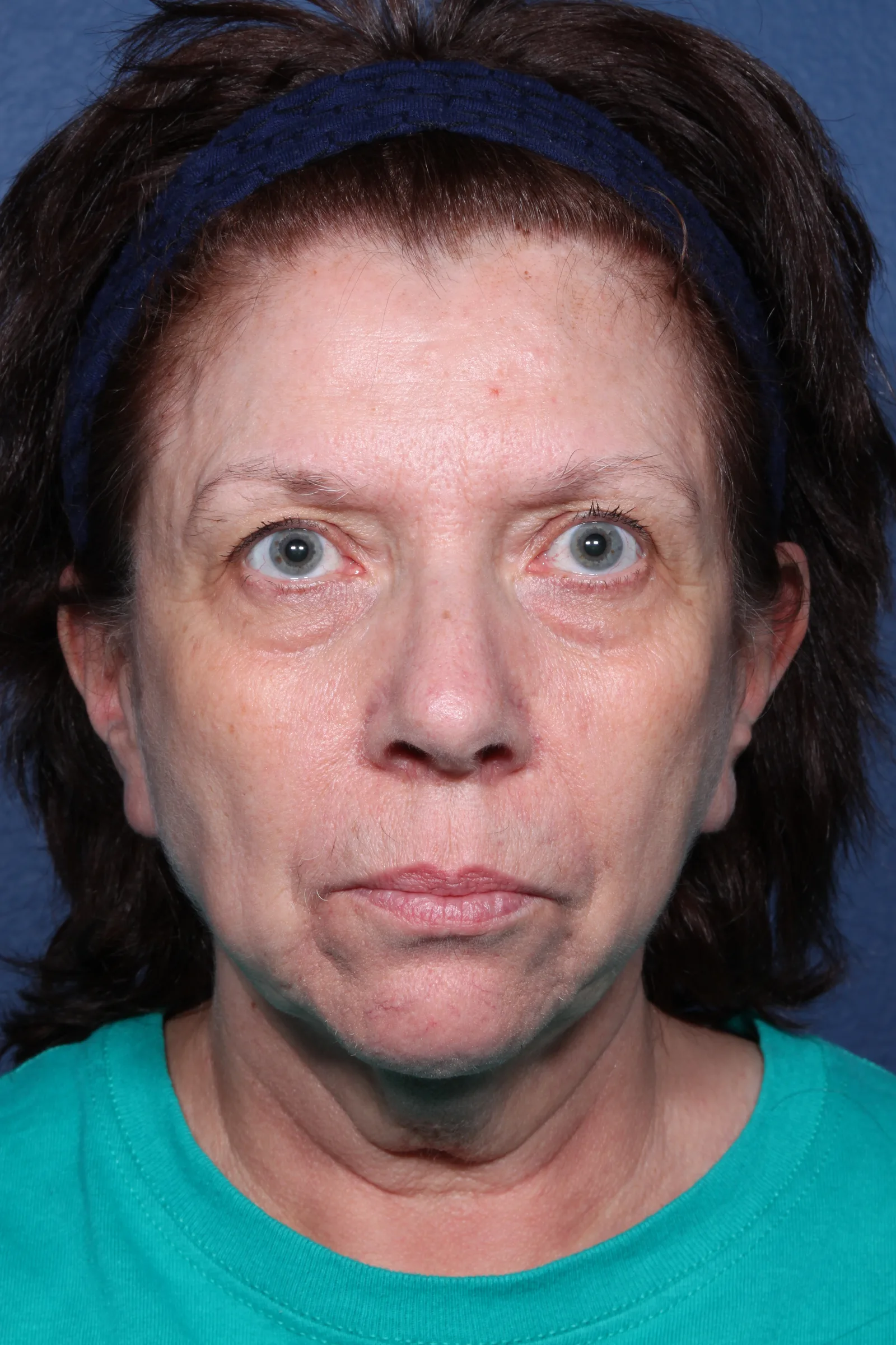 Detail face and neck lift case 2 at Skin Secrets