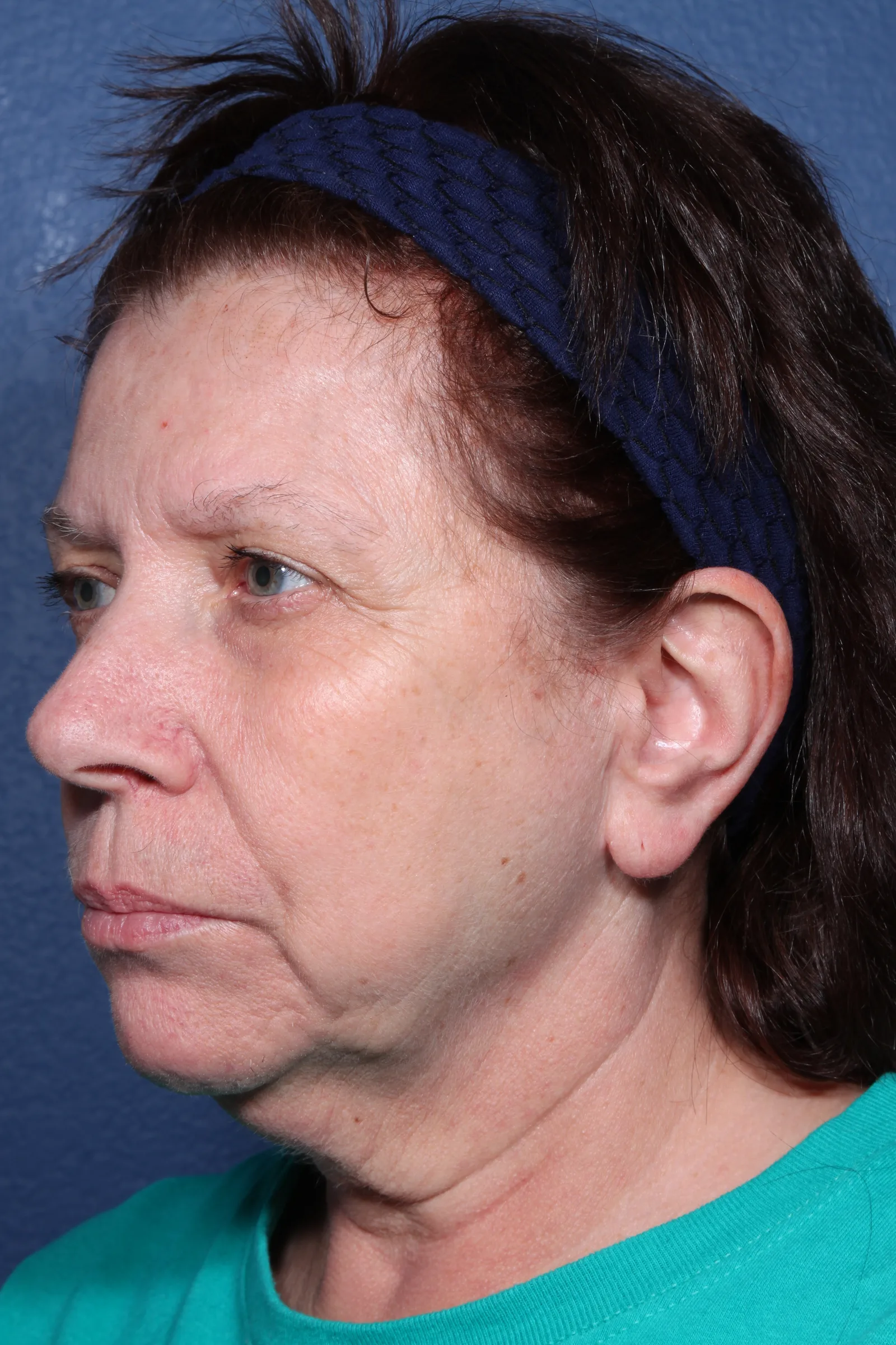 Detail face and neck lift case 2 at Skin Secrets