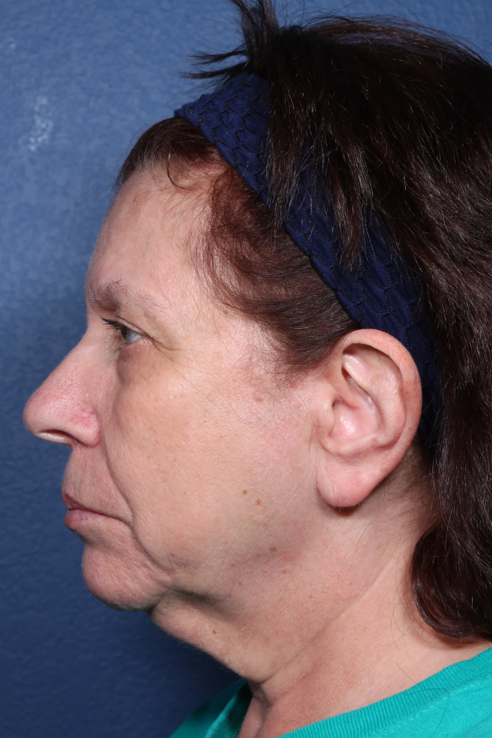 Detail face and neck lift case 2 at Skin Secrets