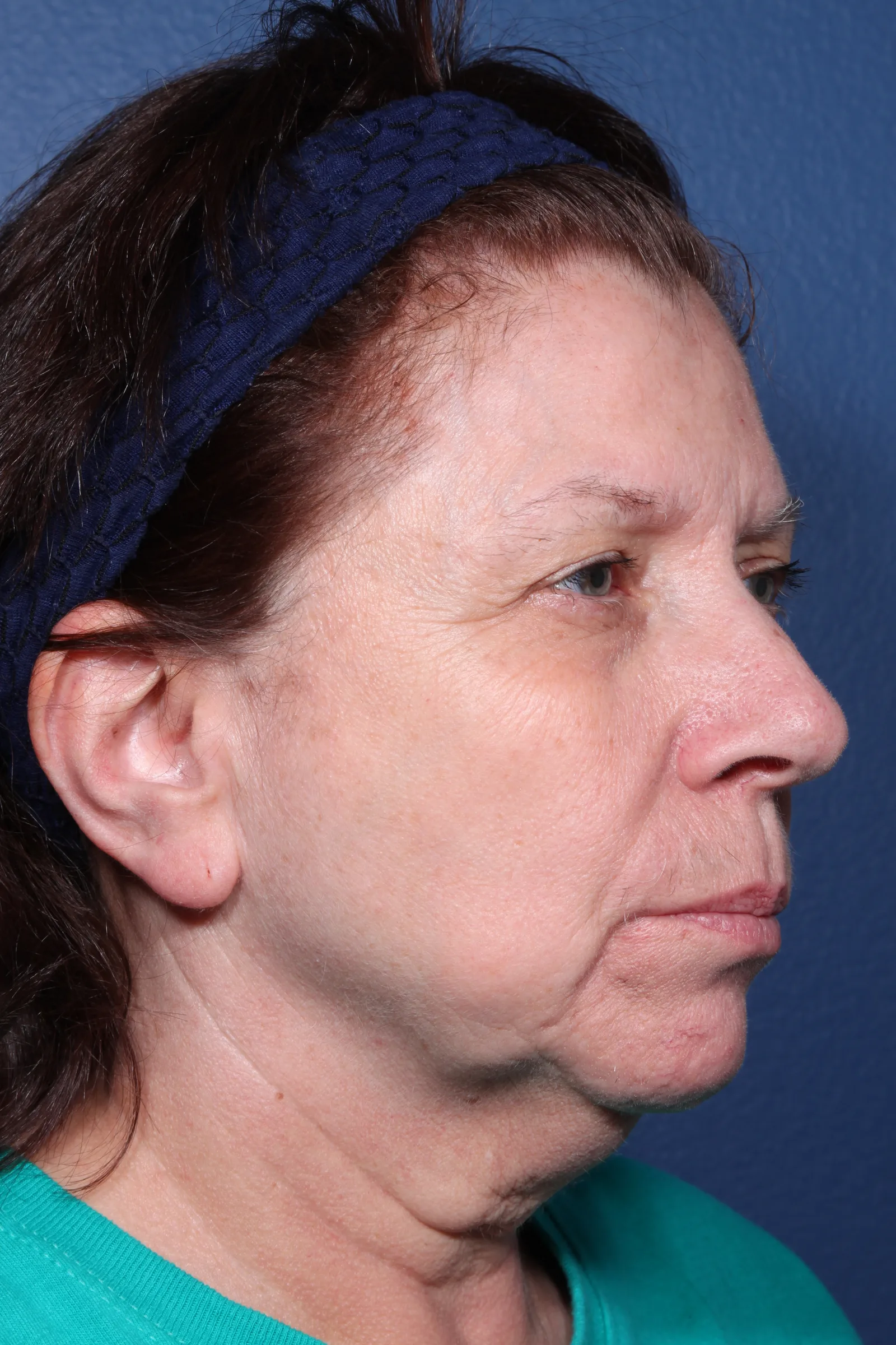 Detail face and neck lift case 2 at Skin Secrets
