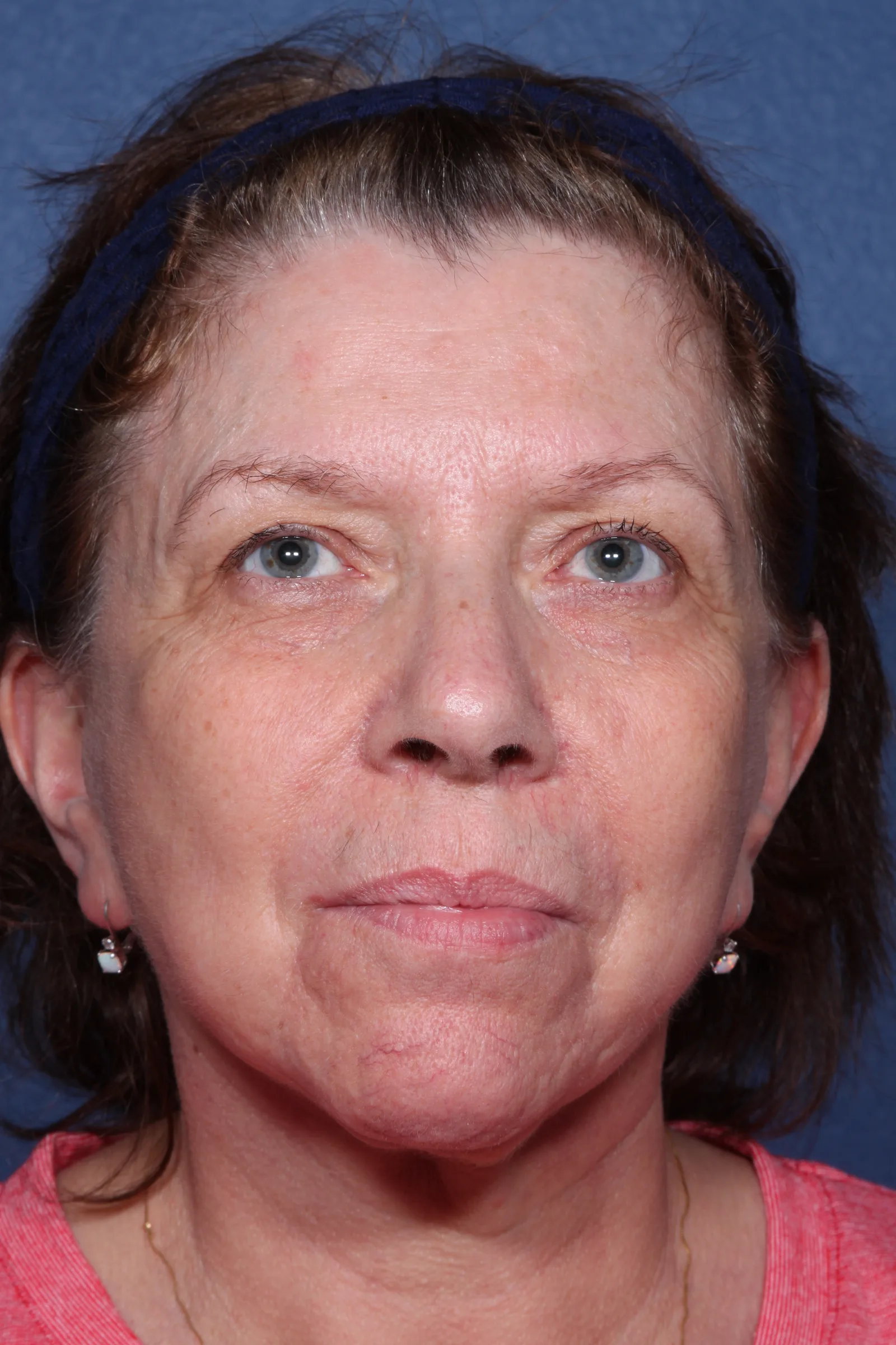 Detail face and neck lift case 2 at Skin Secrets
