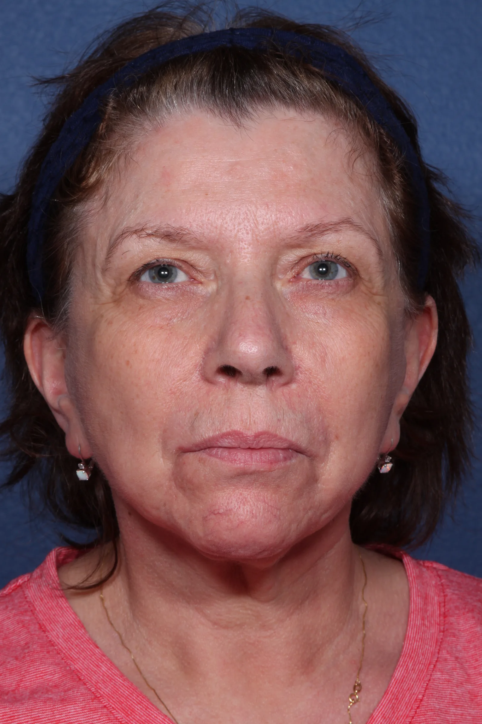 Detail face and neck lift case 2 at Skin Secrets