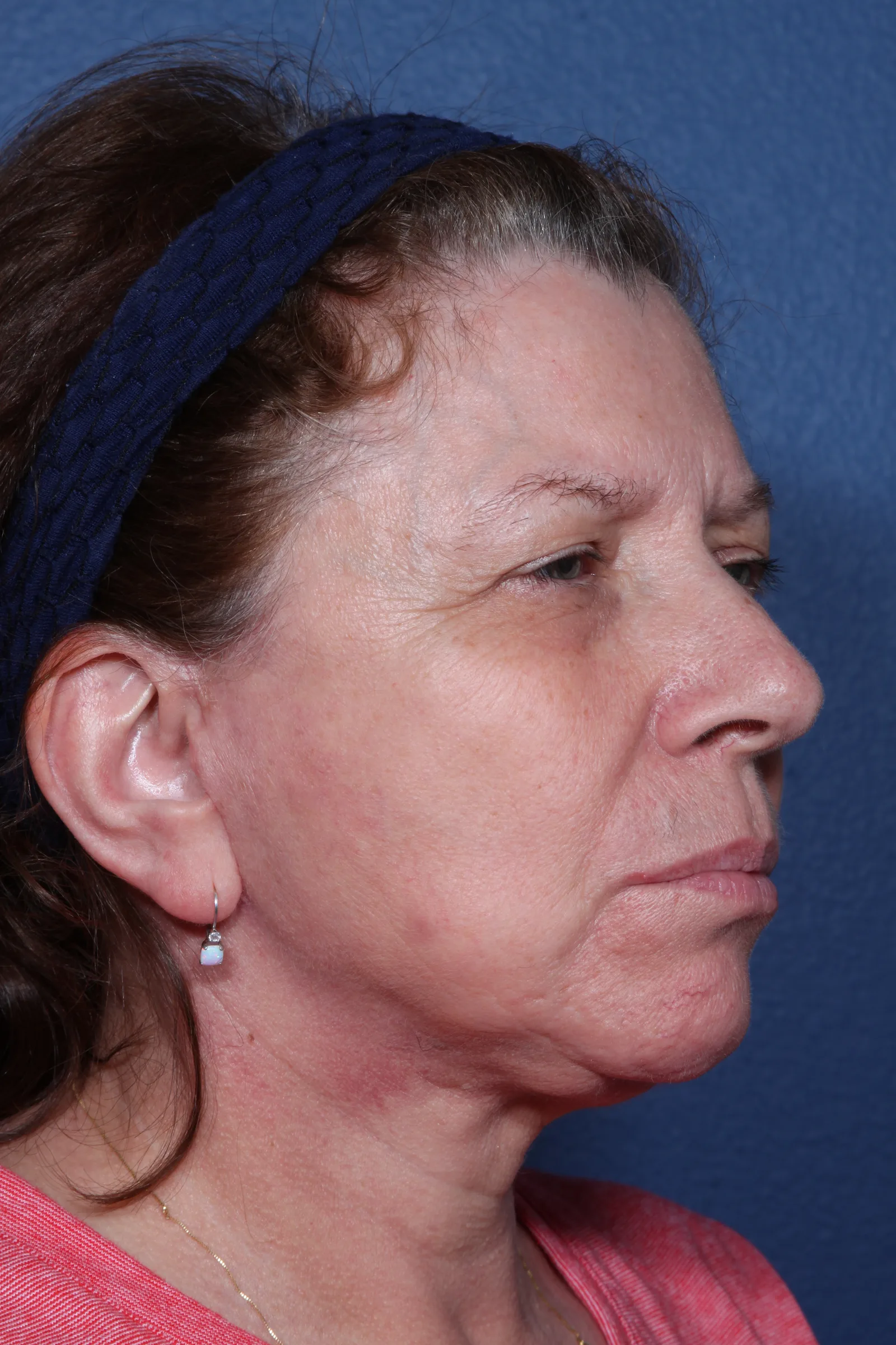 Detail face and neck lift case 2 at Skin Secrets