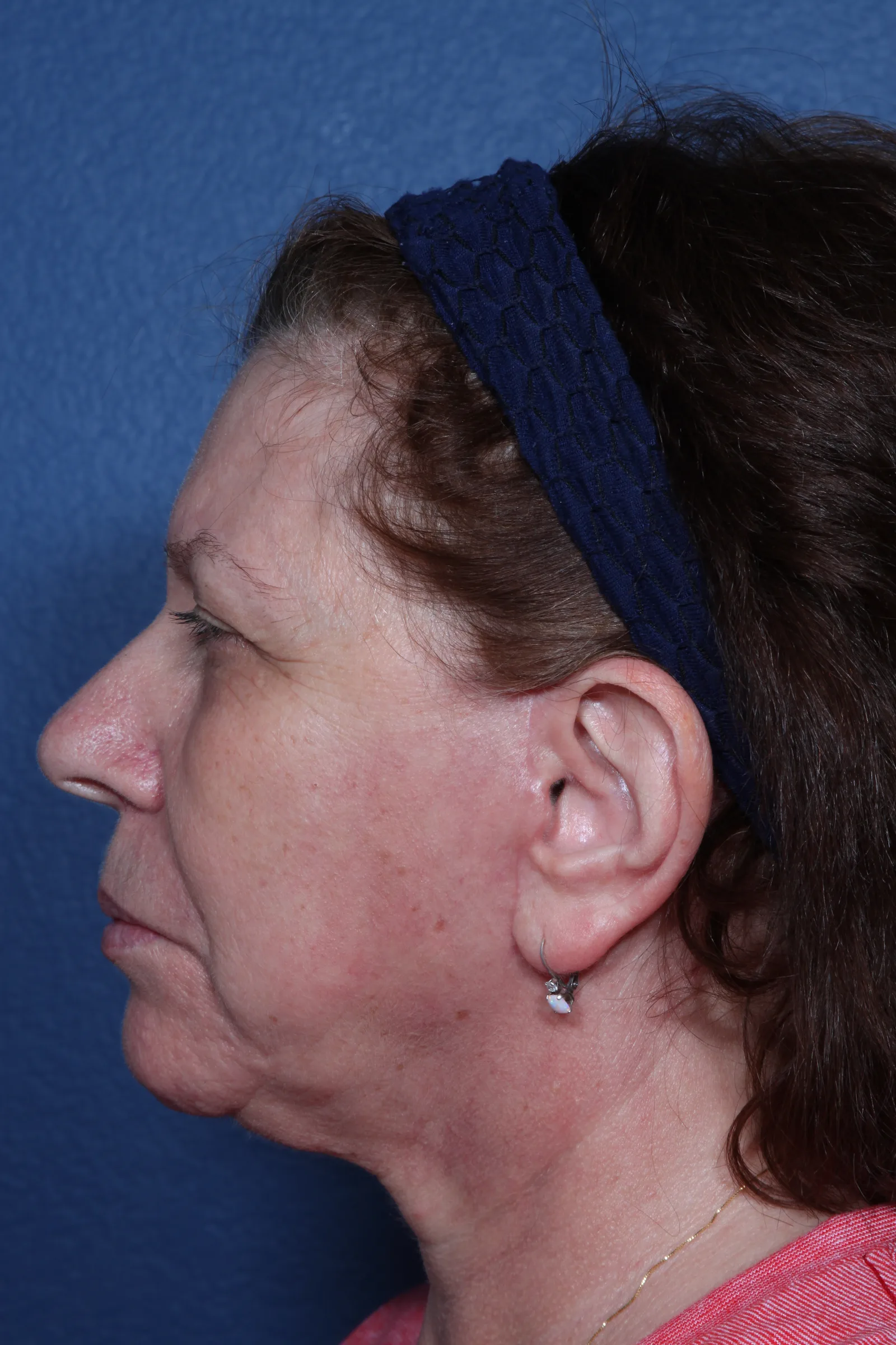 Detail face and neck lift case 2 at Skin Secrets