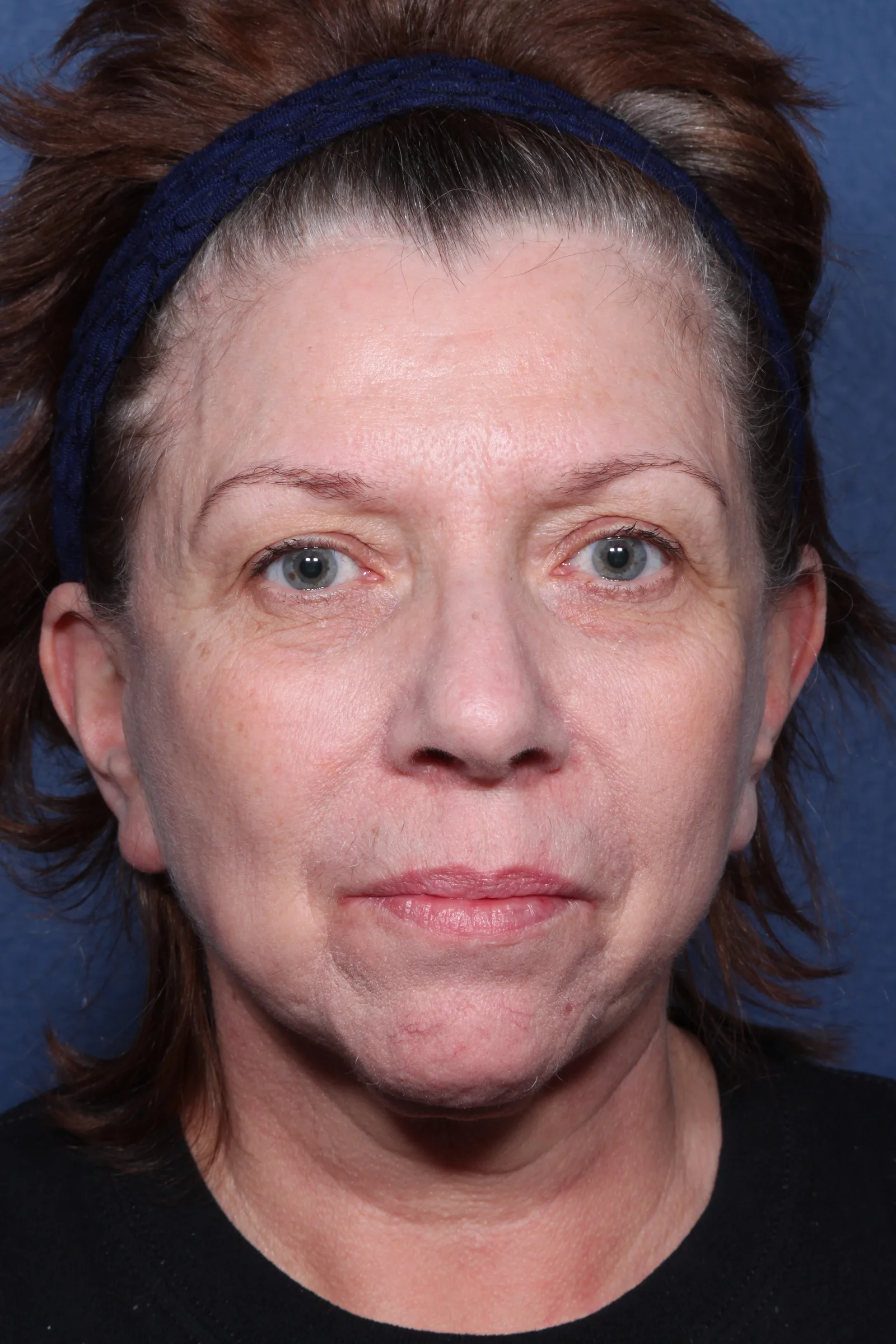 Detail face and neck lift case 2 at Skin Secrets