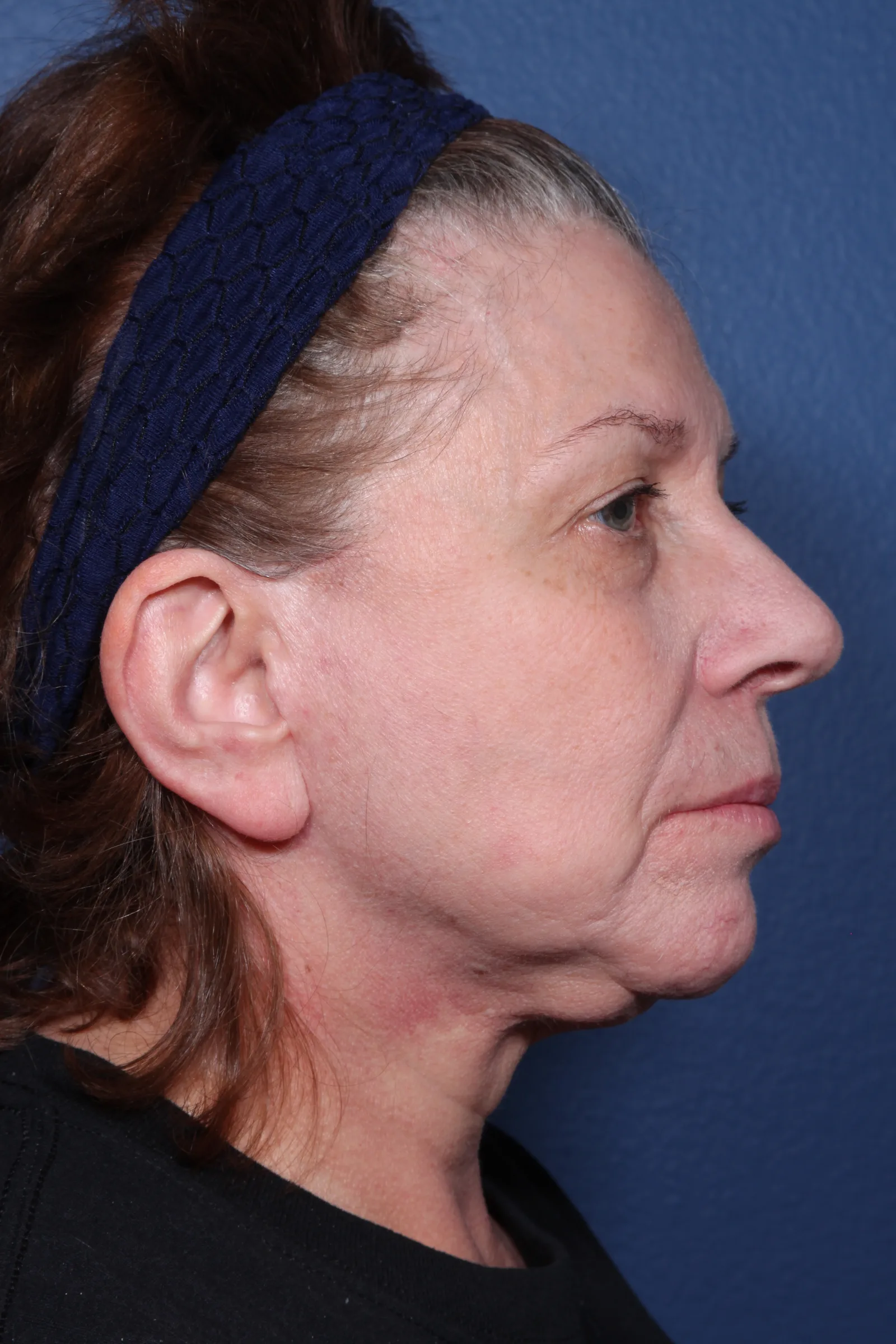 Detail face and neck lift case 2 at Skin Secrets