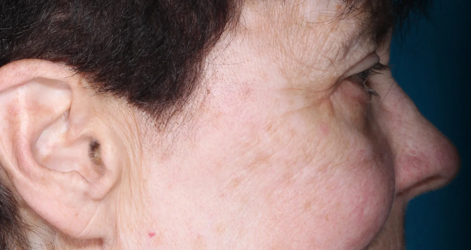After cosmetic lower lid blepharoplasty case 1 at Skin Secrets
