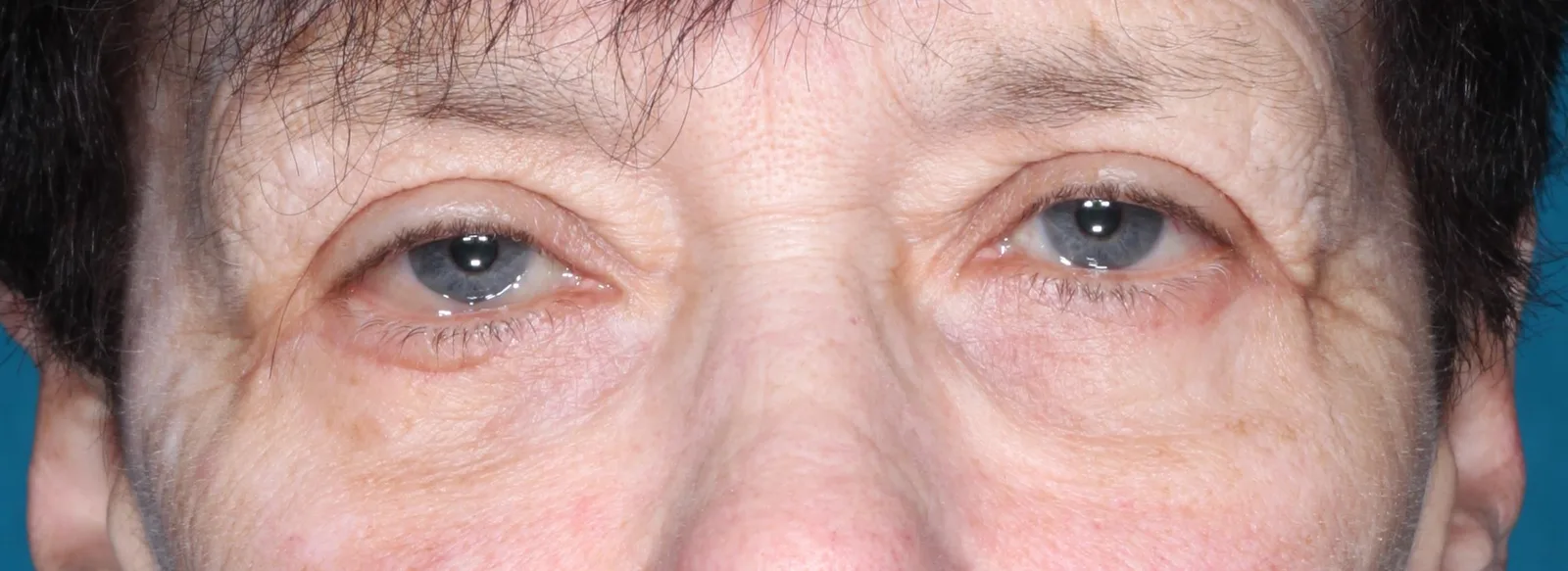 After cosmetic lower lid blepharoplasty case 1 at Skin Secrets