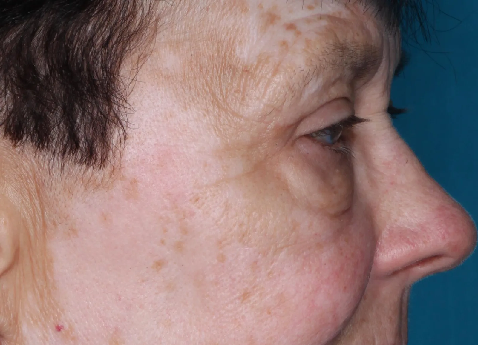 Before cosmetic lower lid blepharoplasty case 1 at Skin Secrets