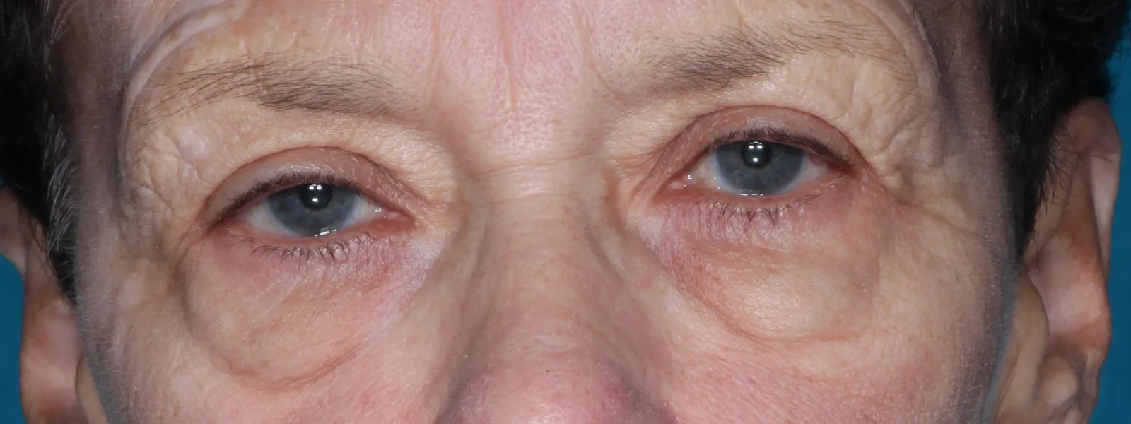 Before cosmetic lower lid blepharoplasty case 1 at Skin Secrets