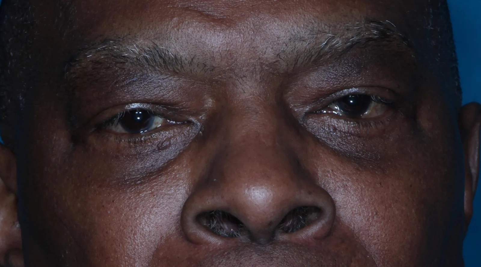 After cosmetic lower lid blepharoplasty case 2 at Skin Secrets