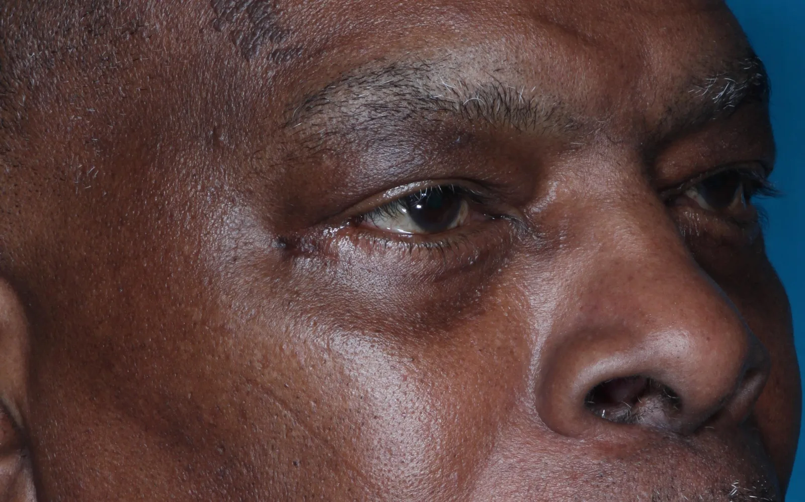 After cosmetic lower lid blepharoplasty case 2 at Skin Secrets