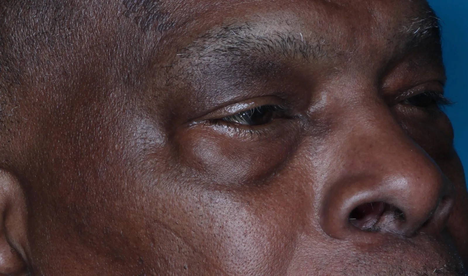 Before cosmetic lower lid blepharoplasty case 2 at Skin Secrets