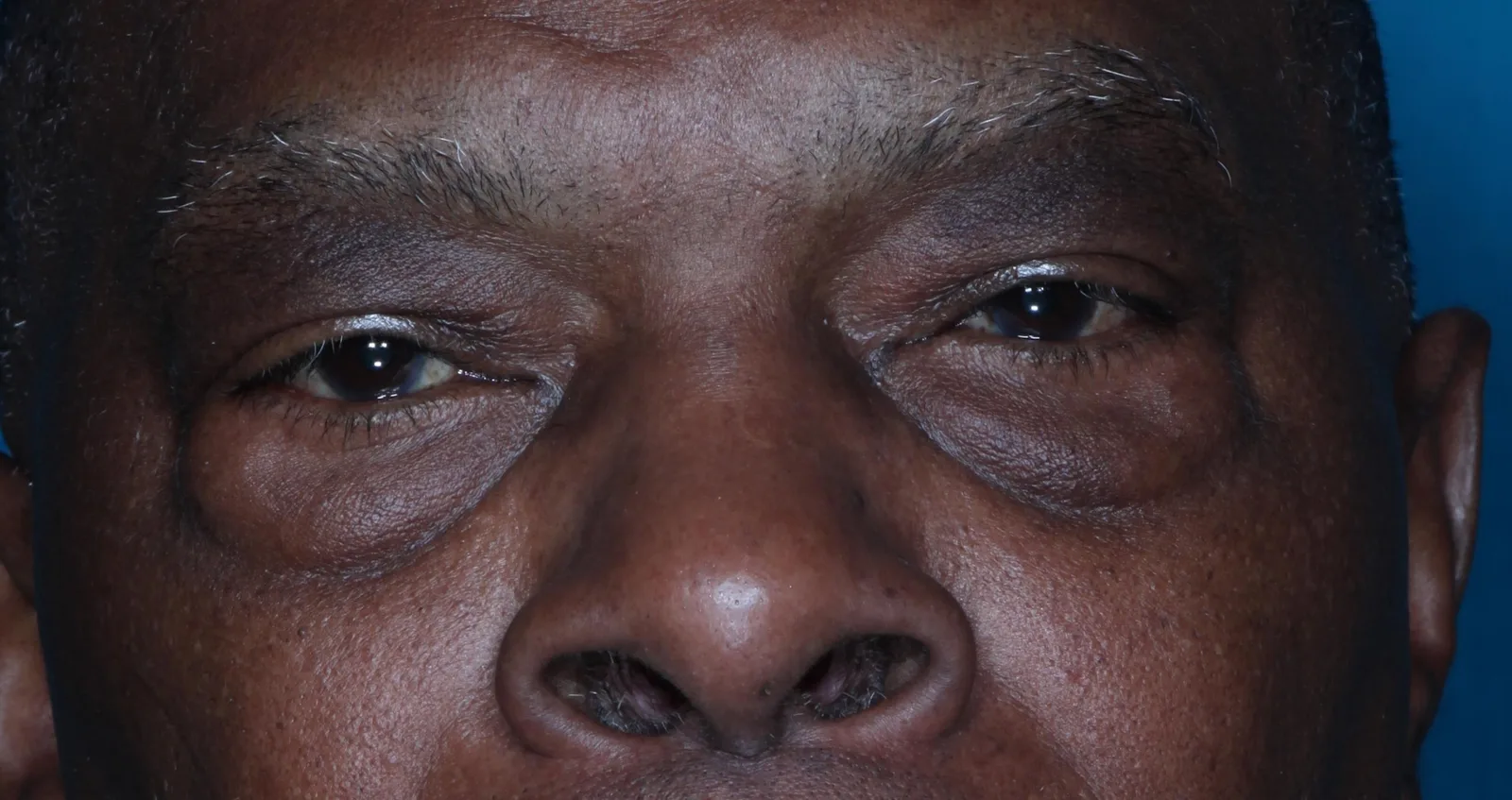 Before cosmetic lower lid blepharoplasty case 2 at Skin Secrets