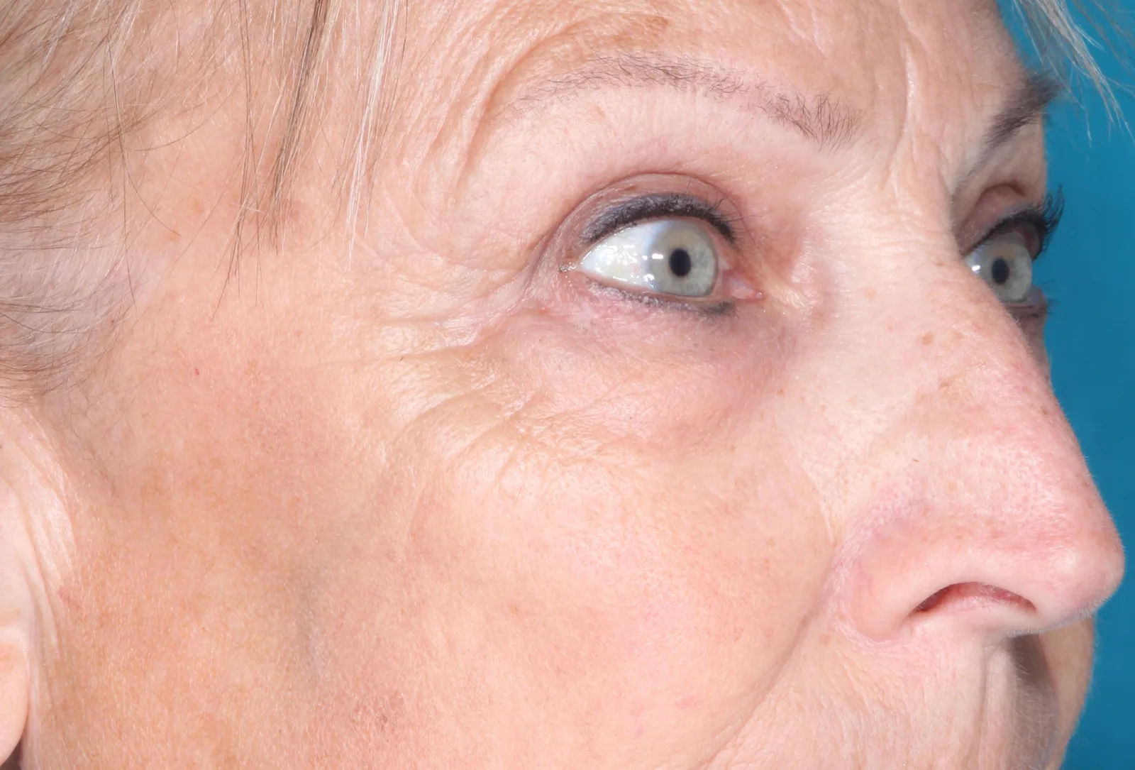 After cosmetic upper lid blepharoplasty case 1 at Skin Secrets