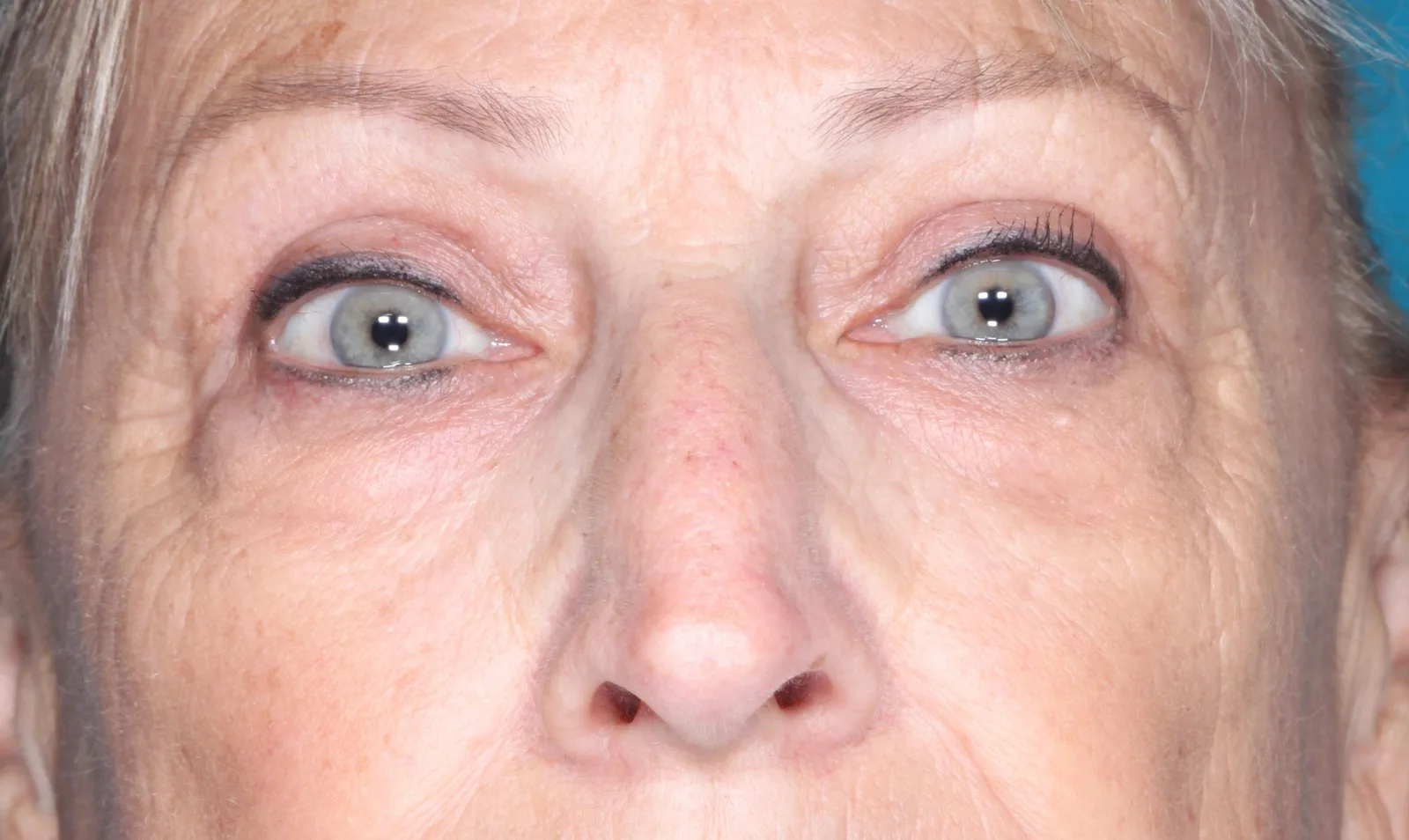 After cosmetic upper lid blepharoplasty case 1 at Skin Secrets