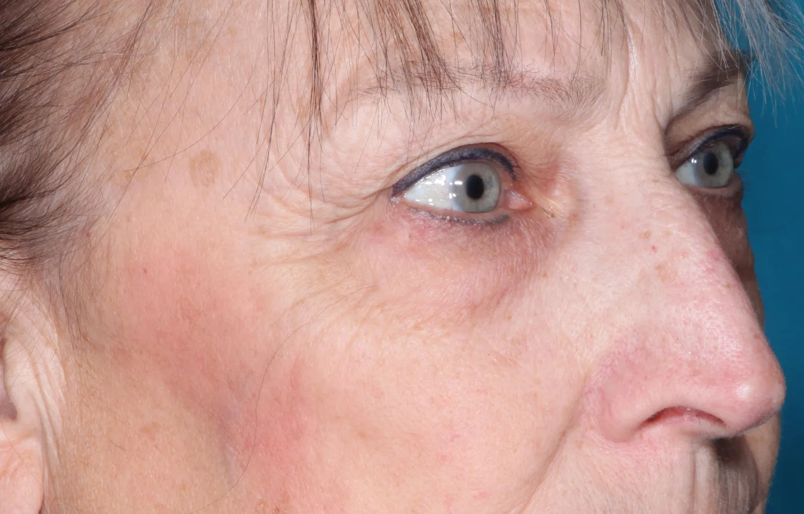 Before cosmetic upper lid blepharoplasty case 1 at Skin Secrets