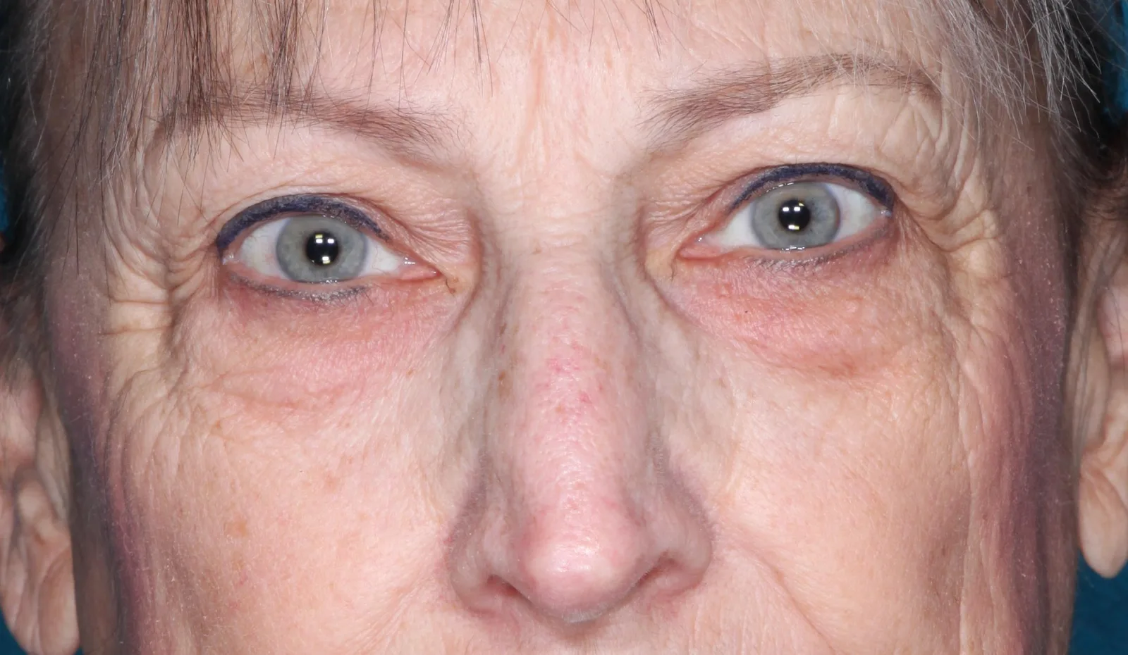 Before cosmetic upper lid blepharoplasty case 1 at Skin Secrets