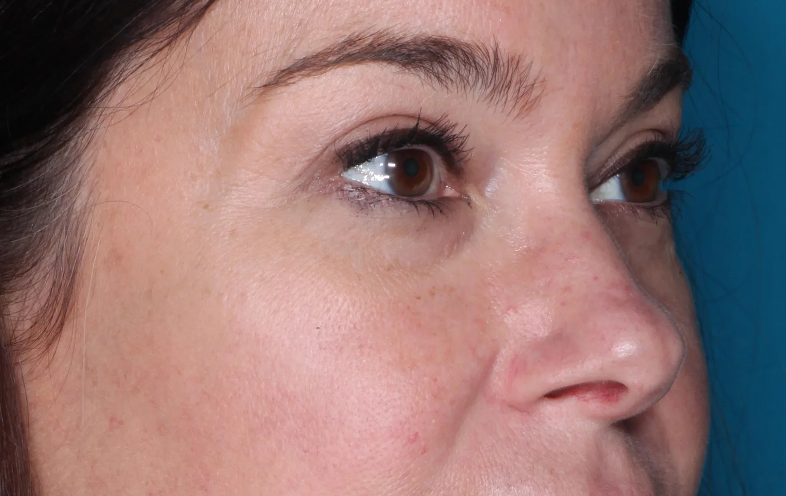 After cosmetic upper lid blepharoplasty case 2 at Skin Secrets