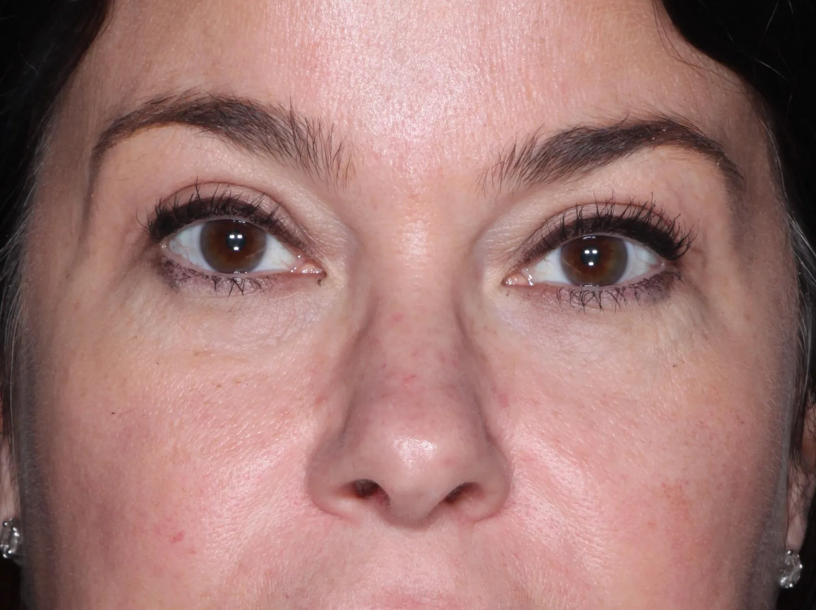 After cosmetic upper lid blepharoplasty case 2 at Skin Secrets