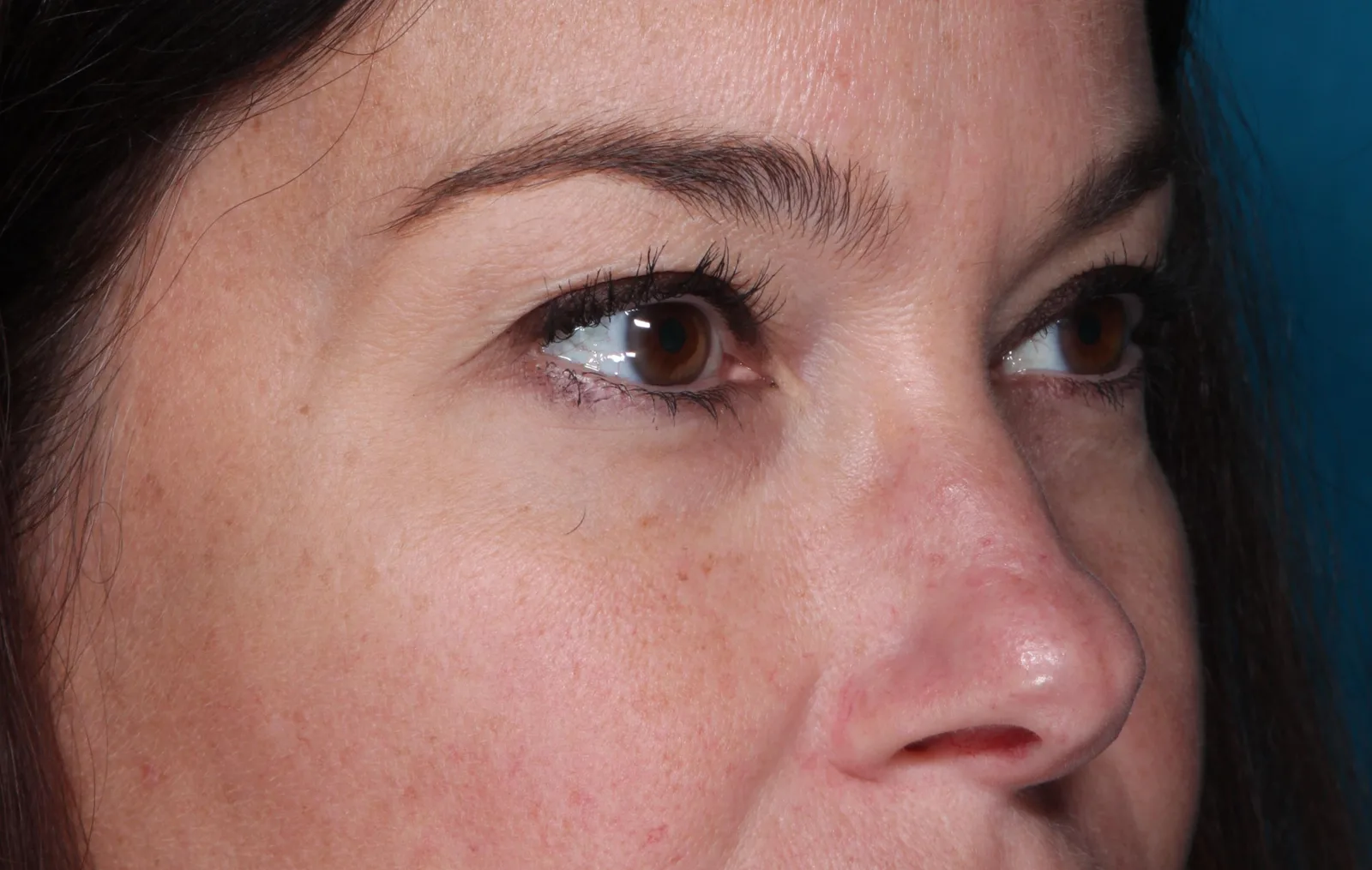Before cosmetic upper lid blepharoplasty case 2 at Skin Secrets