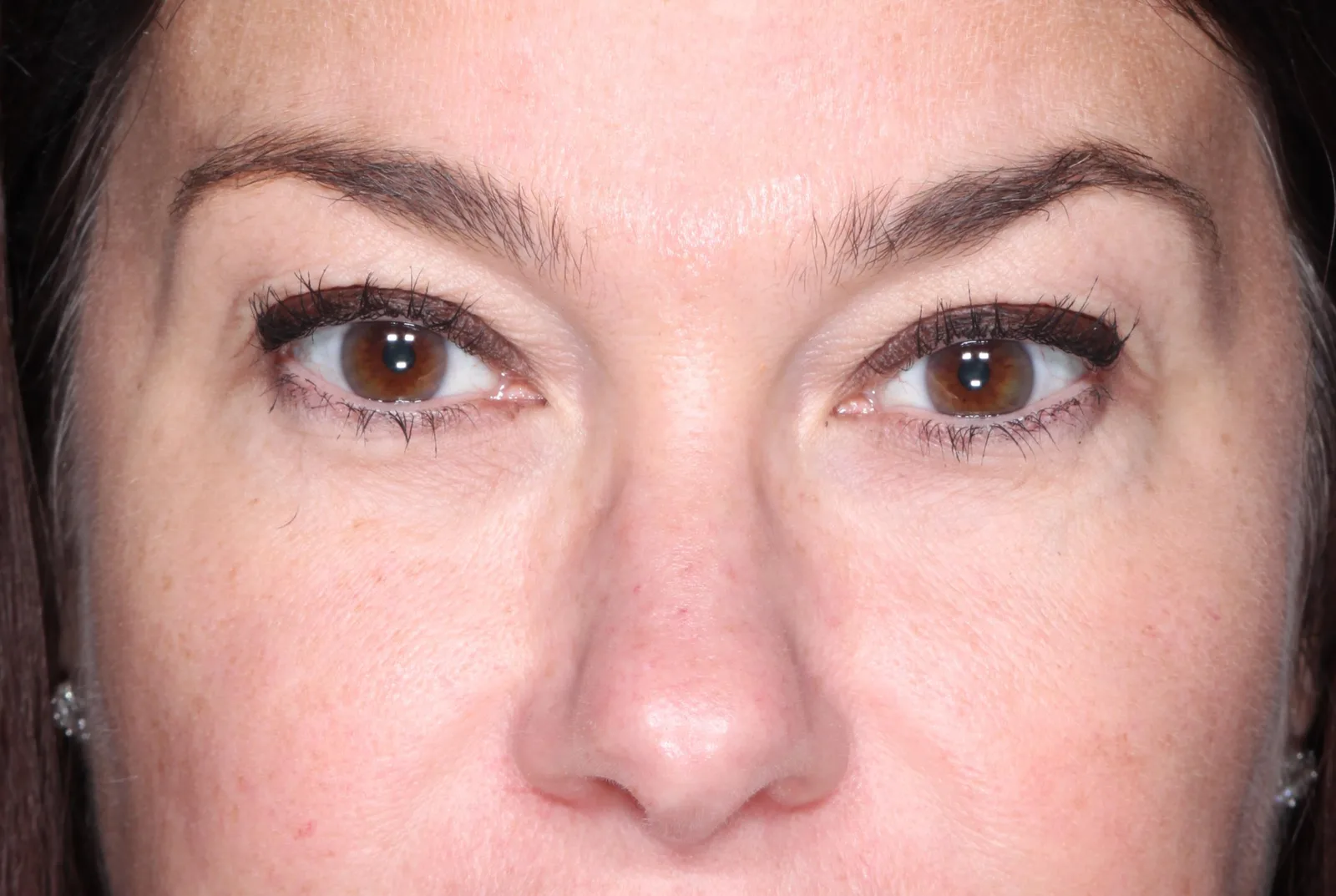 Before cosmetic upper lid blepharoplasty case 2 at Skin Secrets