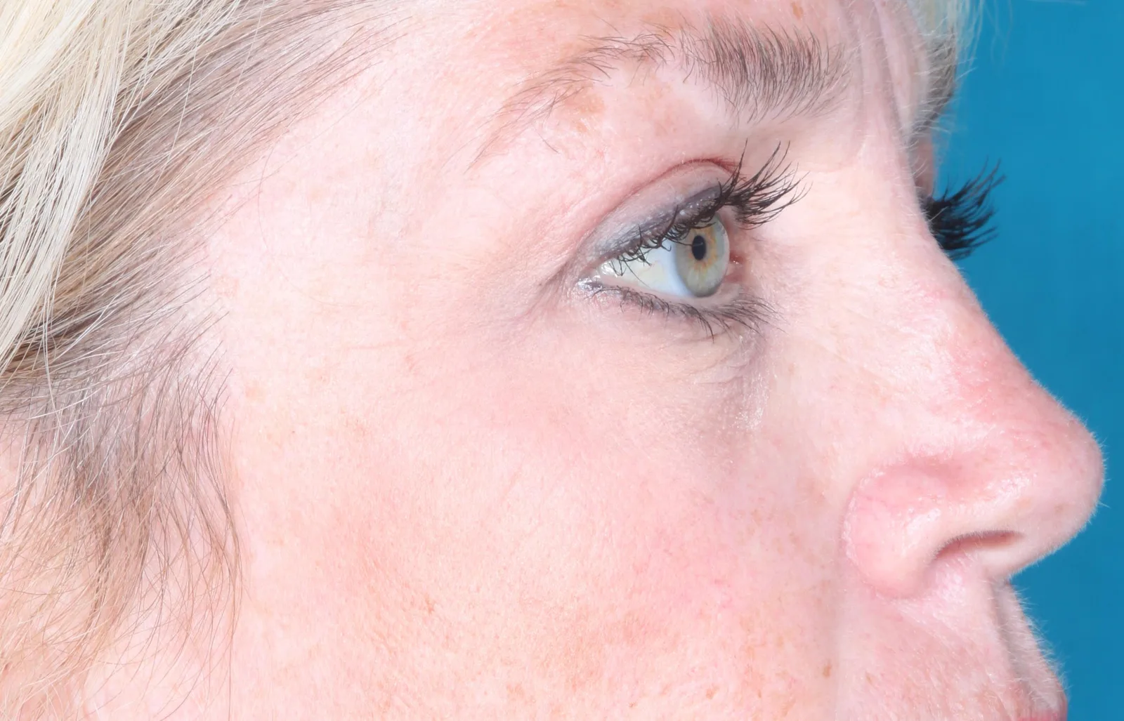 After cosmetic upper lid blepharoplasty case 3 at Skin Secrets