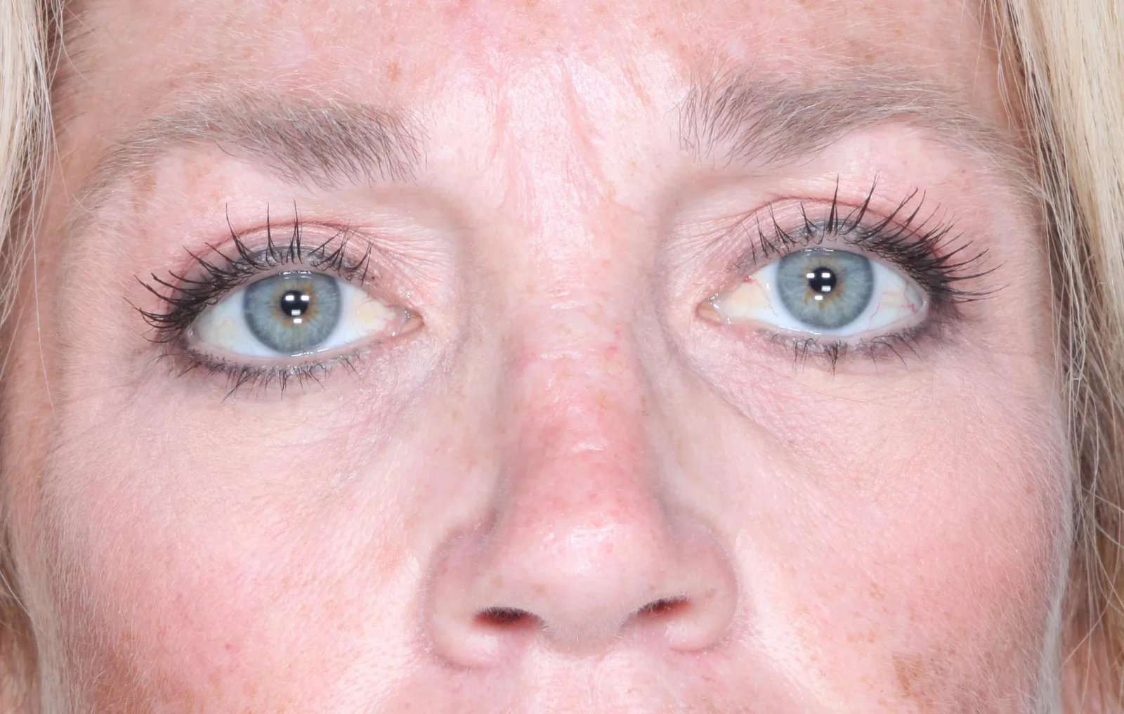 After cosmetic upper lid blepharoplasty case 3 at Skin Secrets