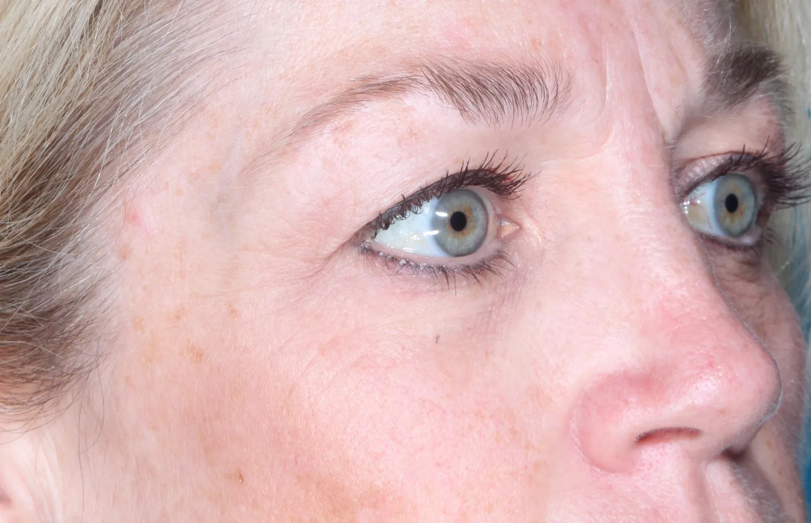 Before cosmetic upper lid blepharoplasty case 3 at Skin Secrets
