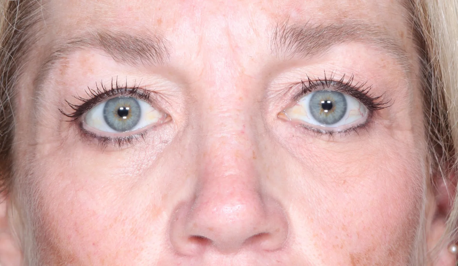 Before cosmetic upper lid blepharoplasty case 3 at Skin Secrets