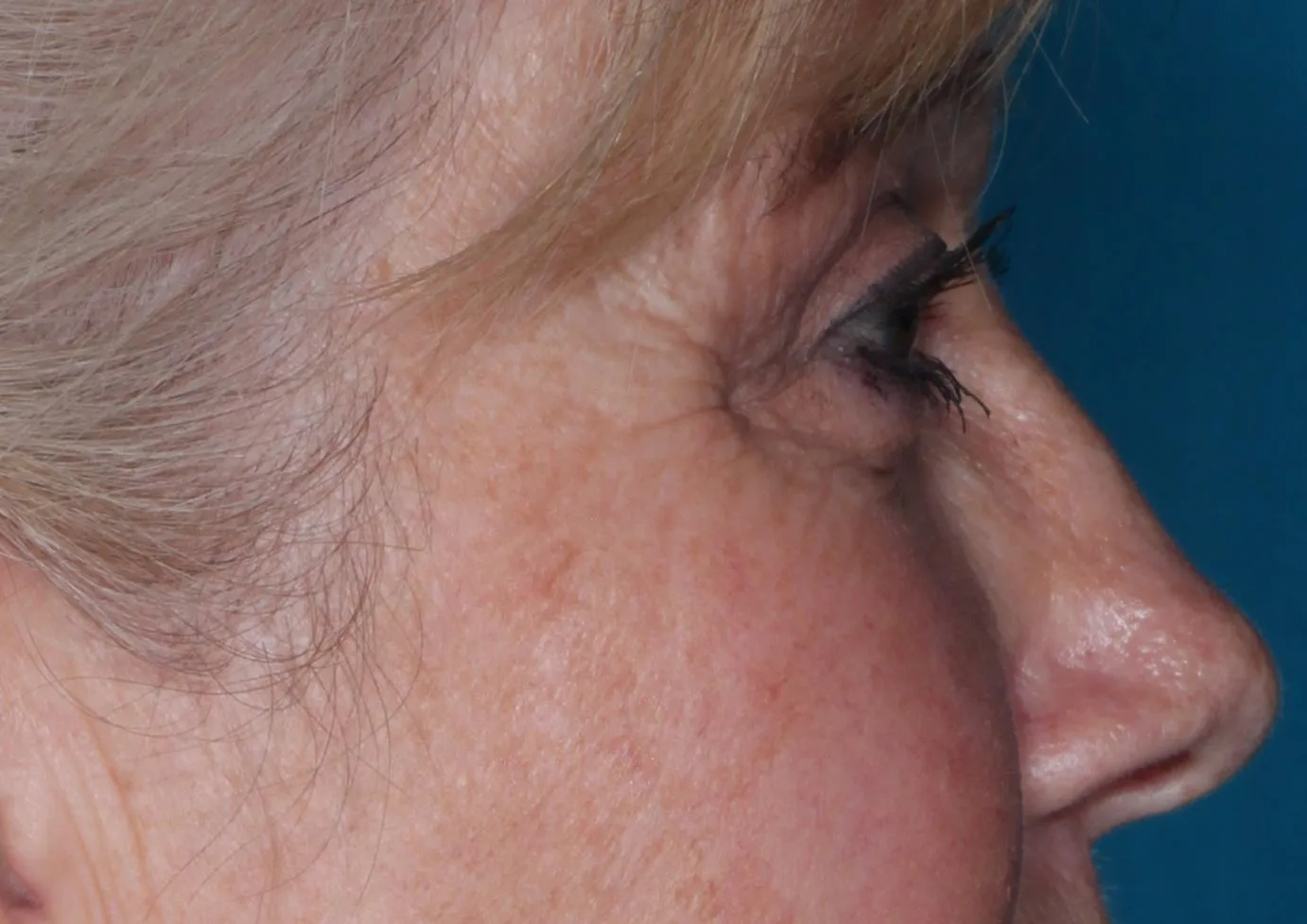 After four-lid blepharoplasty blepharoplasty case 1 at Skin Secrets