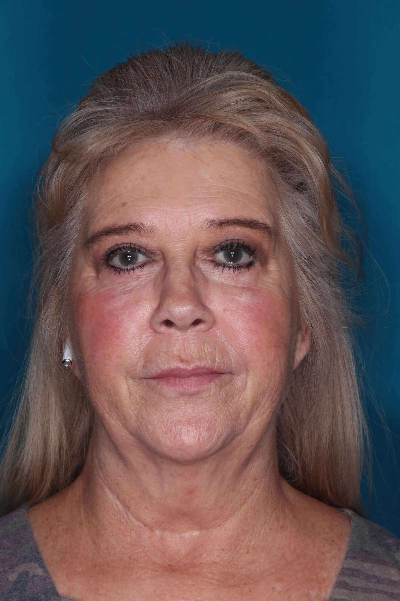 After four-lid blepharoplasty blepharoplasty case 1 at Skin Secrets