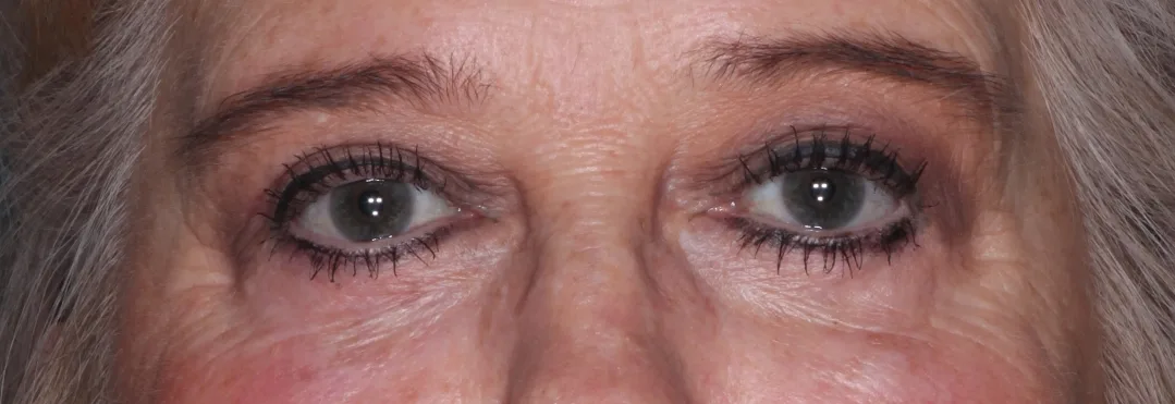 After four-lid blepharoplasty blepharoplasty case 1 at Skin Secrets