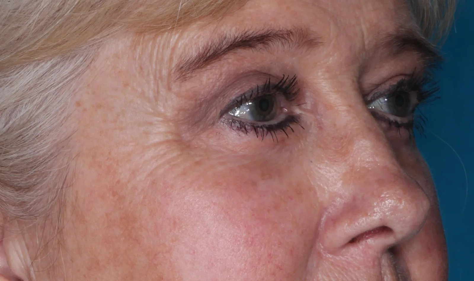 After four-lid blepharoplasty blepharoplasty case 1 at Skin Secrets