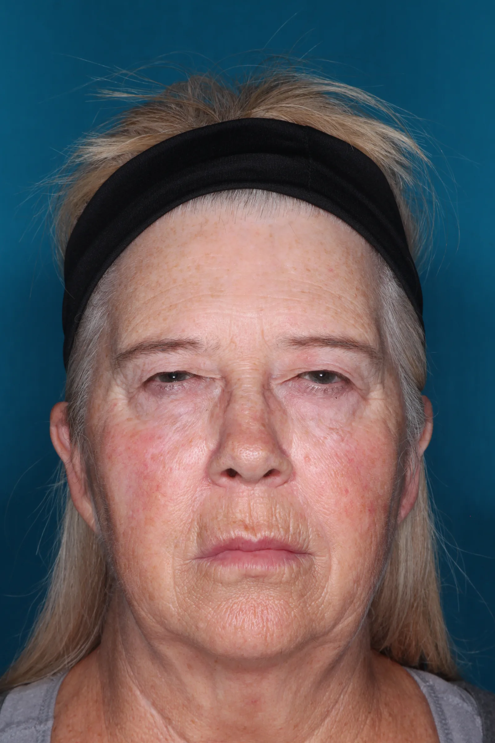 Before four-lid blepharoplasty blepharoplasty case 1 at Skin Secrets