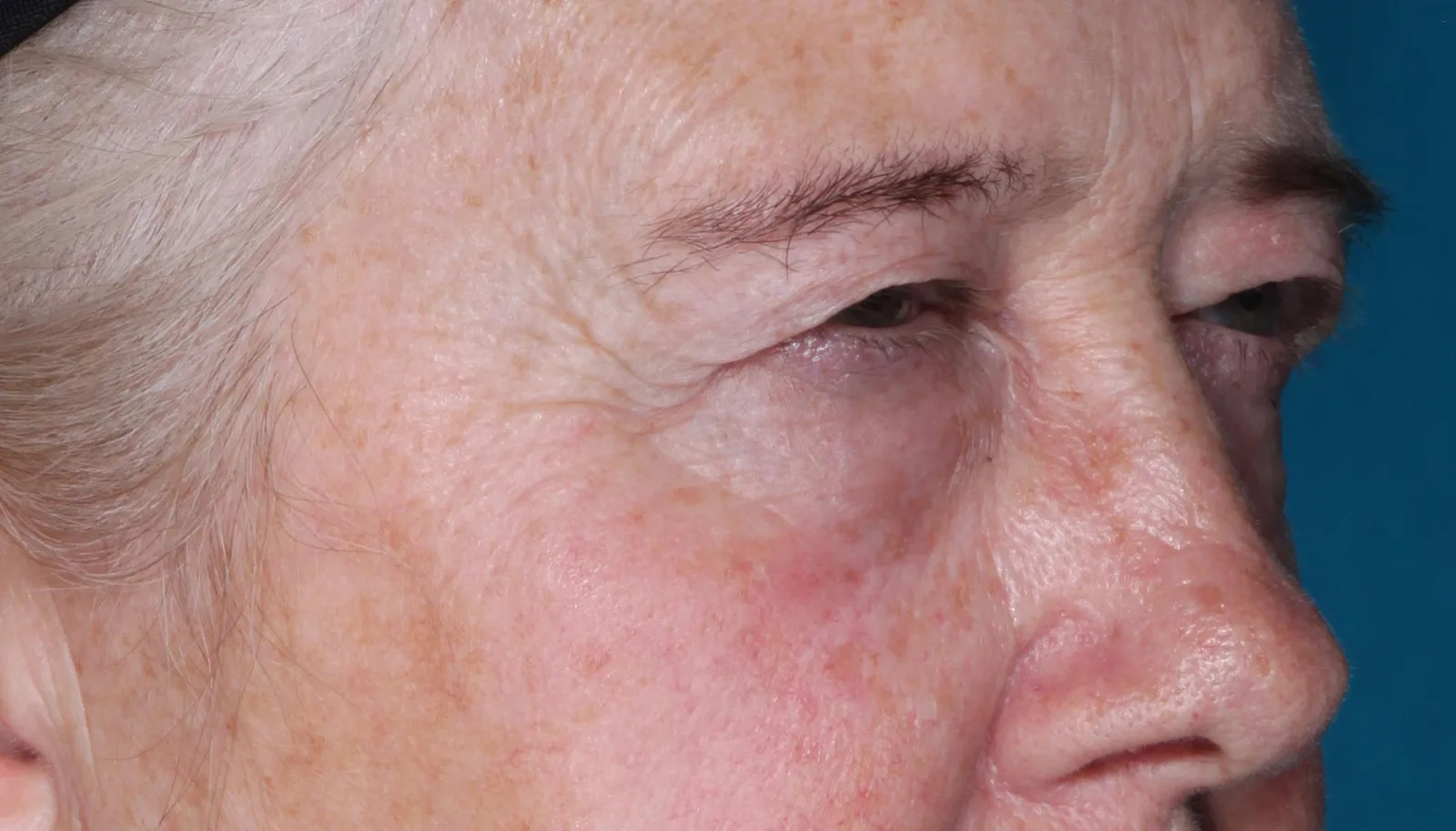 Before four-lid blepharoplasty blepharoplasty case 1 at Skin Secrets