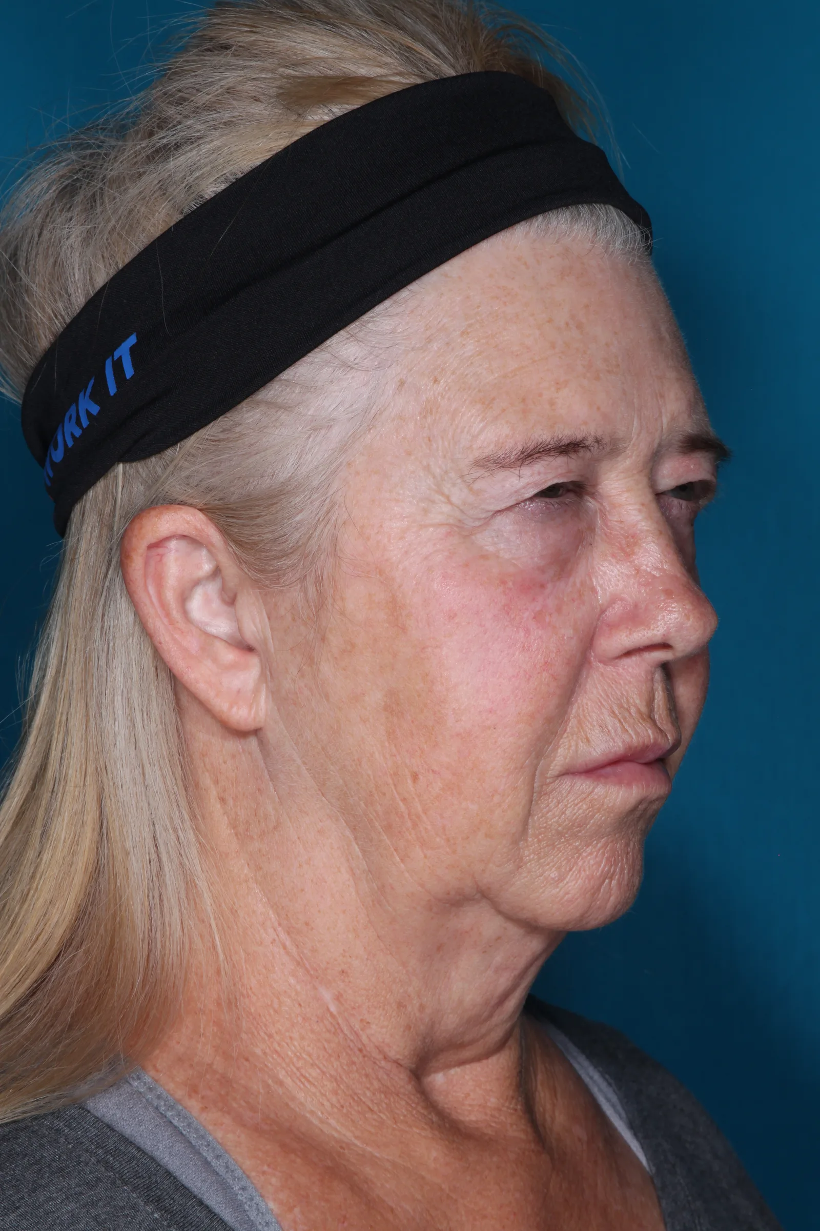 Before four-lid blepharoplasty blepharoplasty case 1 at Skin Secrets