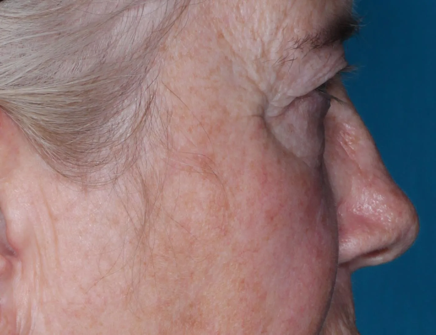 Before four-lid blepharoplasty blepharoplasty case 1 at Skin Secrets