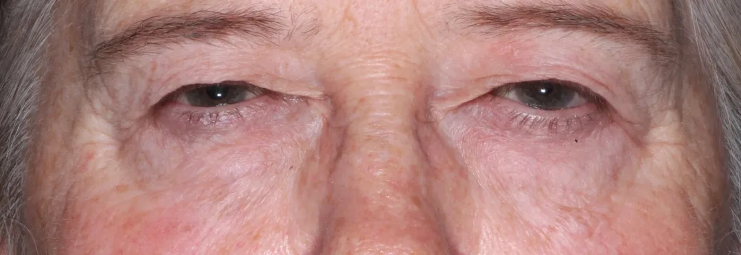 Before four-lid blepharoplasty blepharoplasty case 1 at Skin Secrets