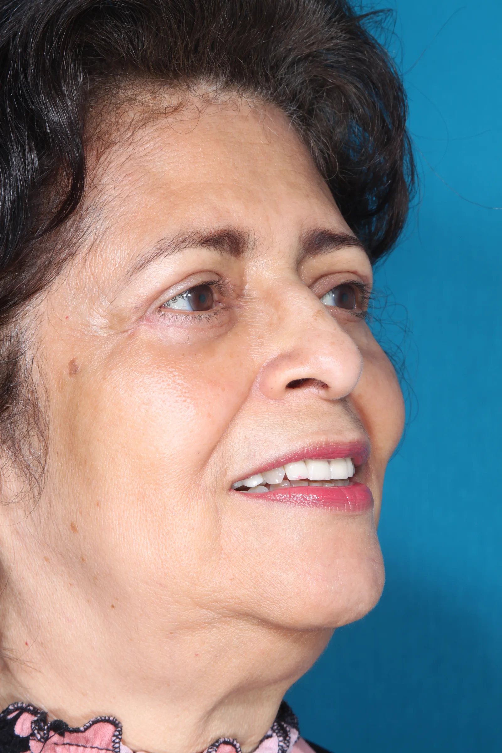 After four-lid blepharoplasty blepharoplasty case 2 at Skin Secrets