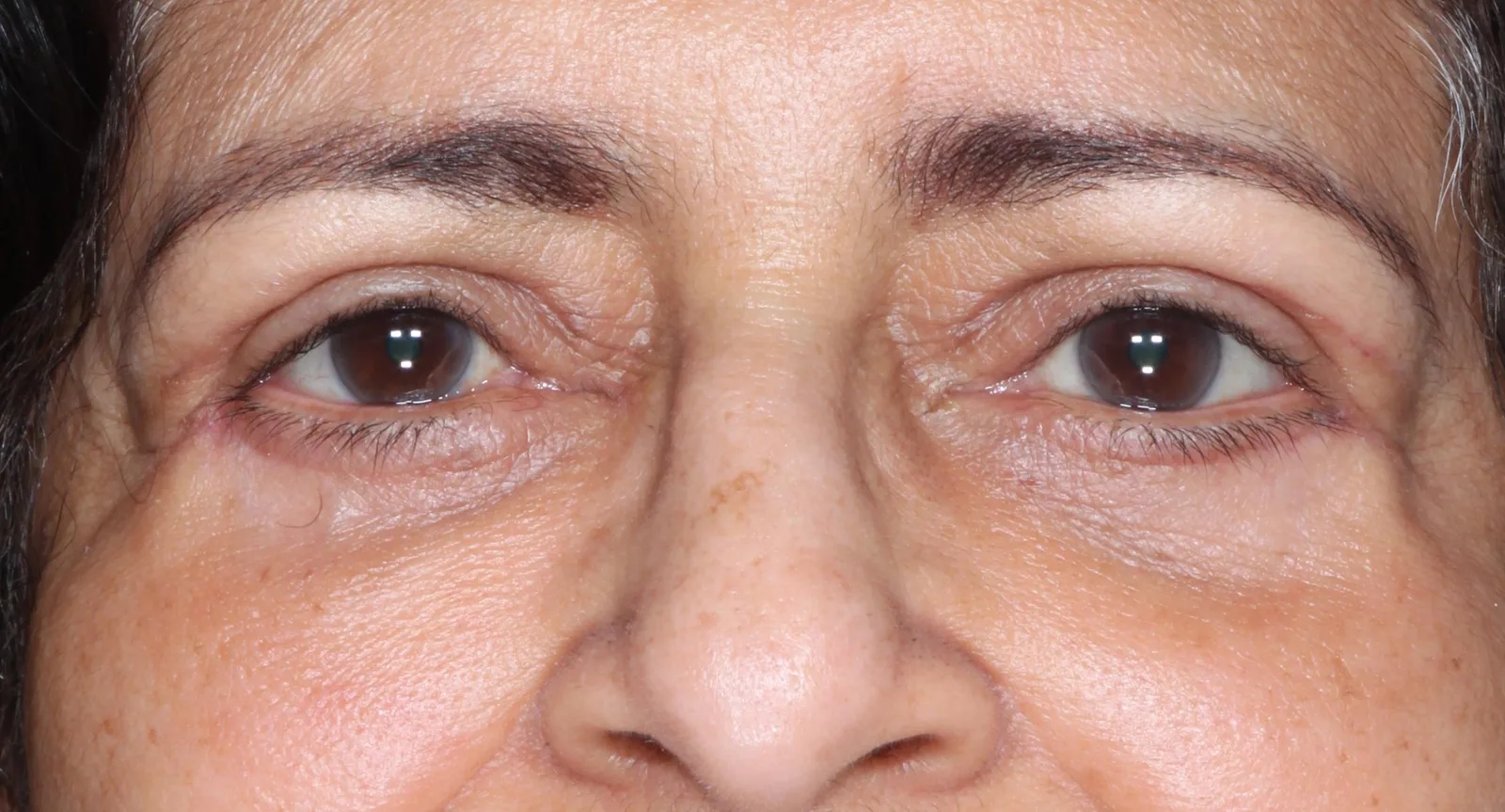After four-lid blepharoplasty blepharoplasty case 2 at Skin Secrets
