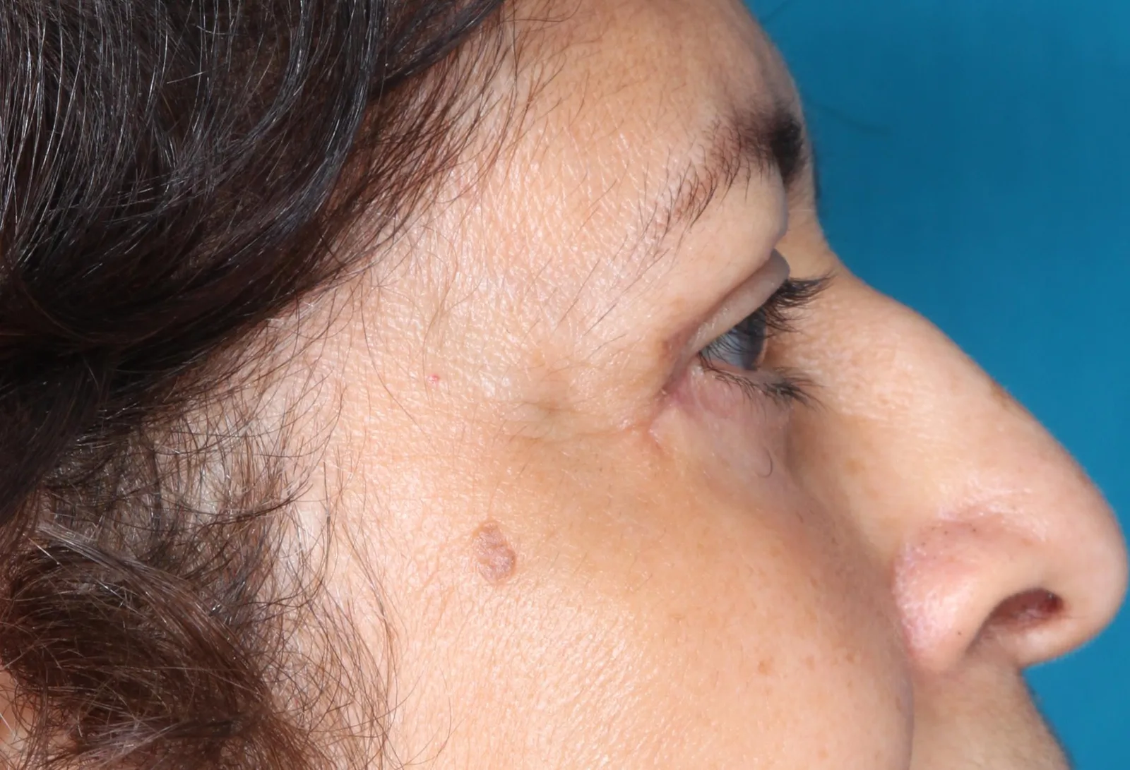 After four-lid blepharoplasty blepharoplasty case 2 at Skin Secrets